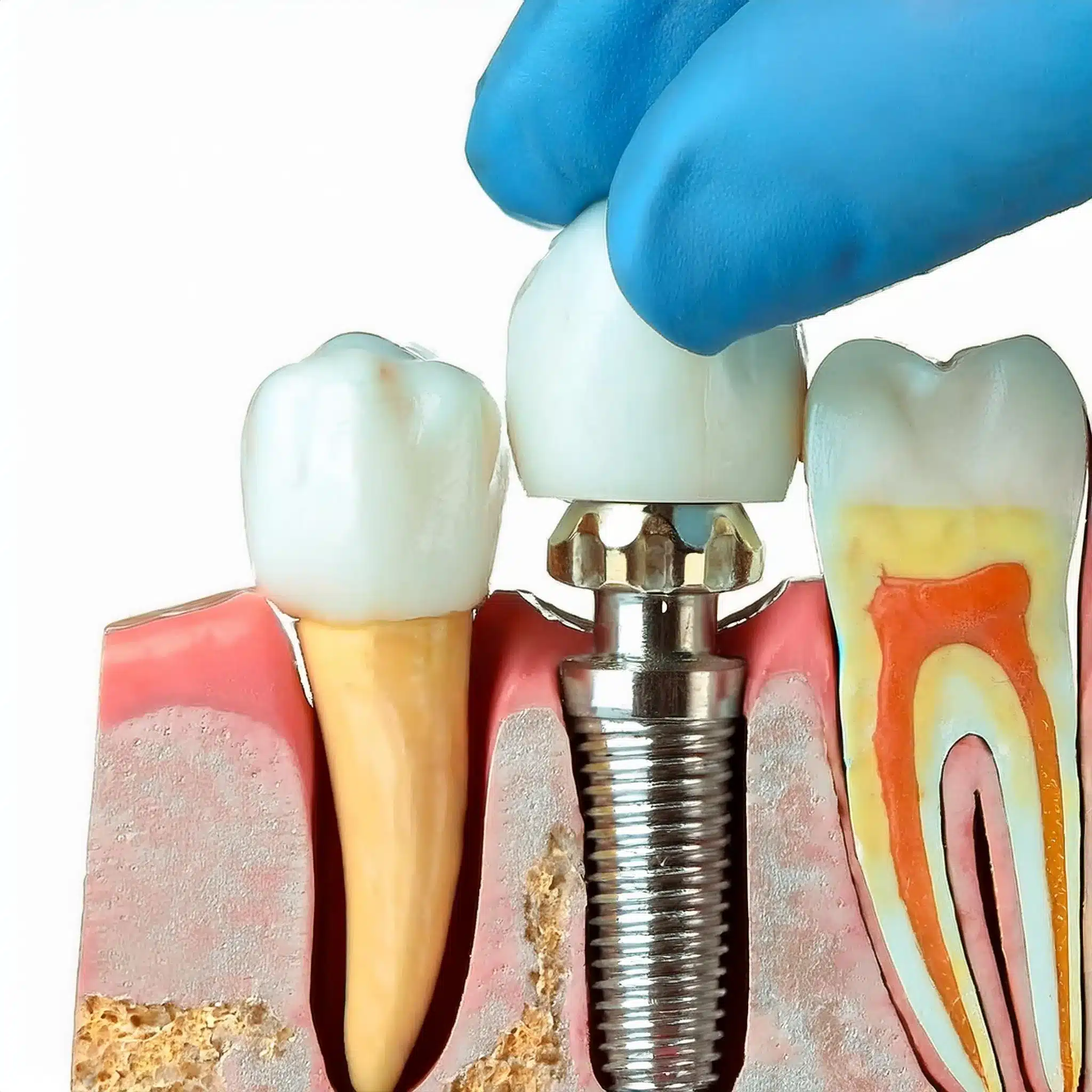 How is a dental implant added?