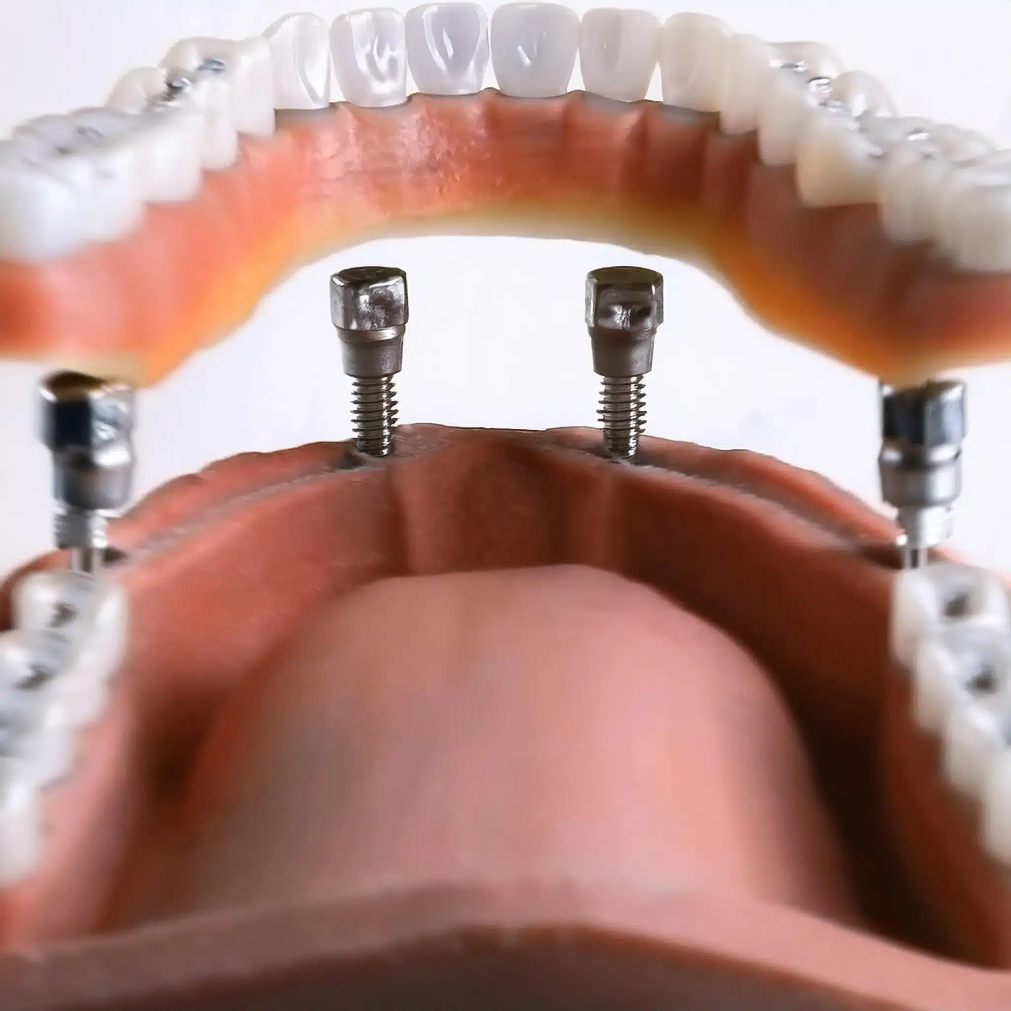 Placement of a dental implant overdenture