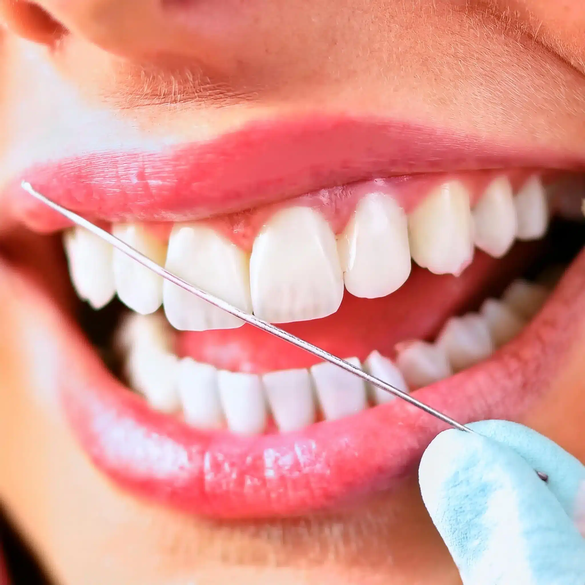 A girl smiling with her new dental implants