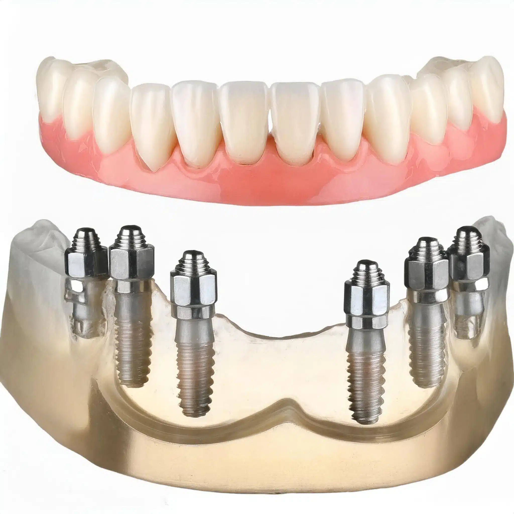 All on 6 dental implants