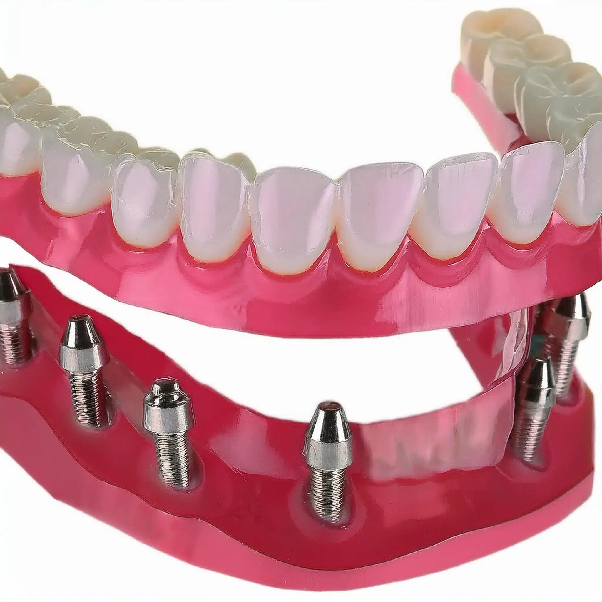 3D plan of full arch dental implants