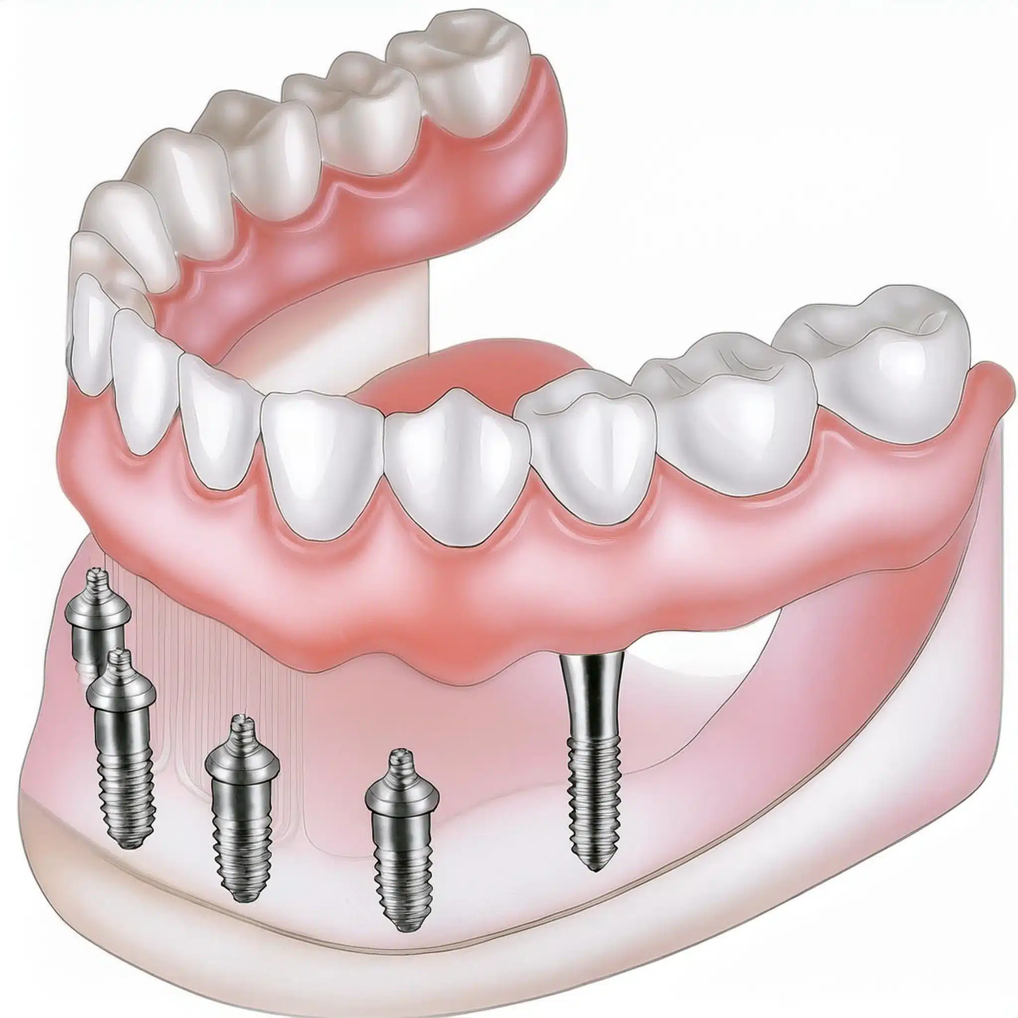 3D plan of dental implants for multiple teeth