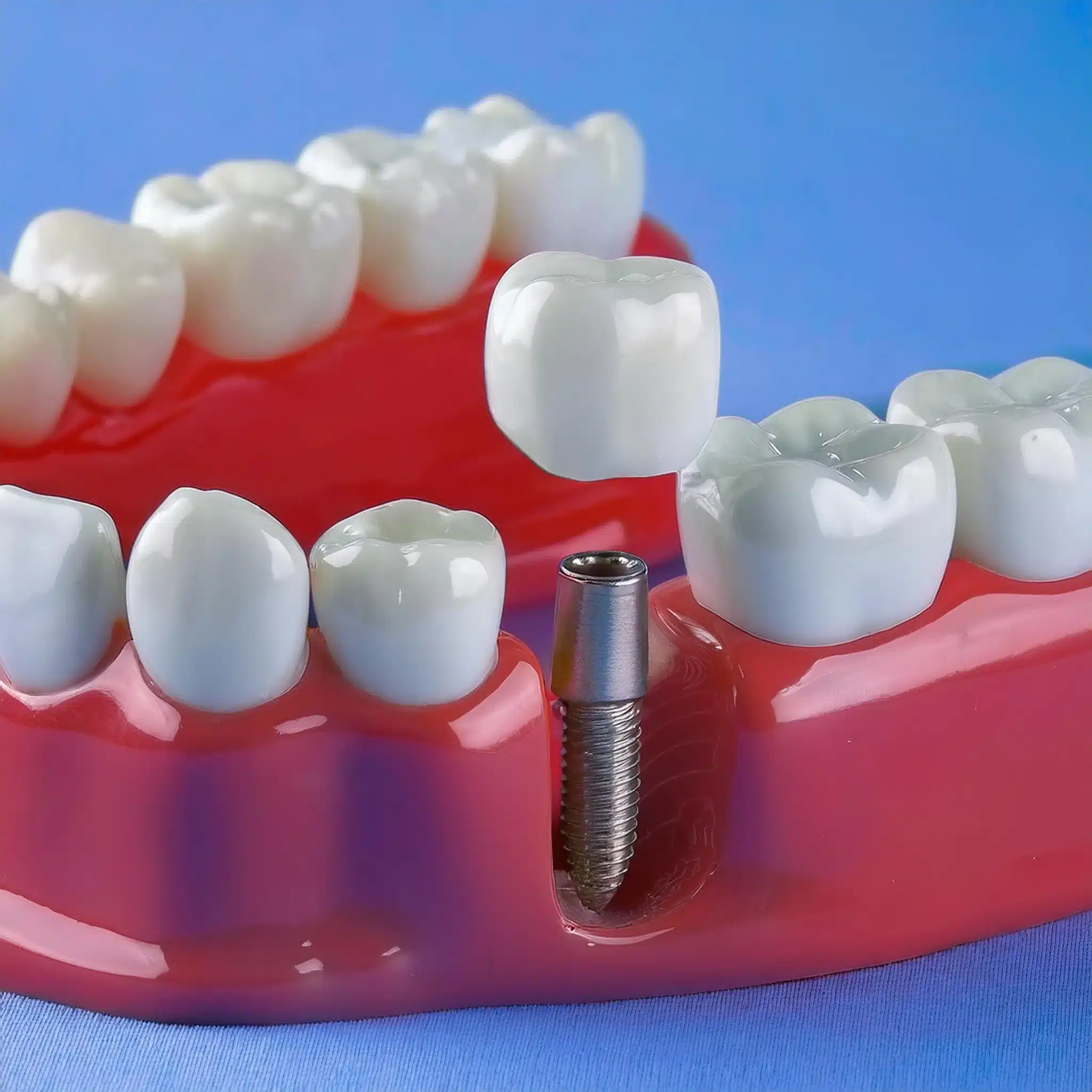 3D plan of dental implant placement