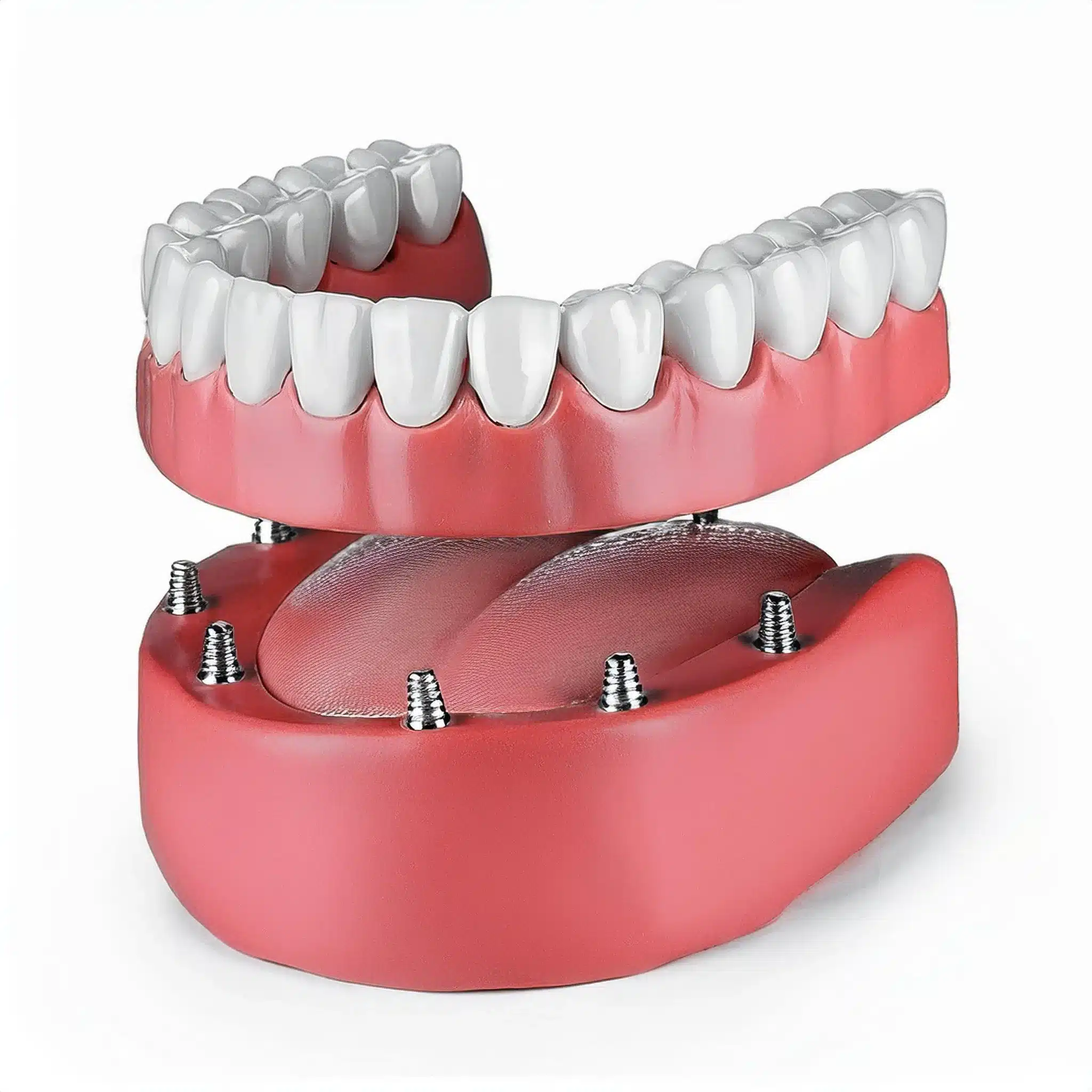 3D plan of dental implant overdenture