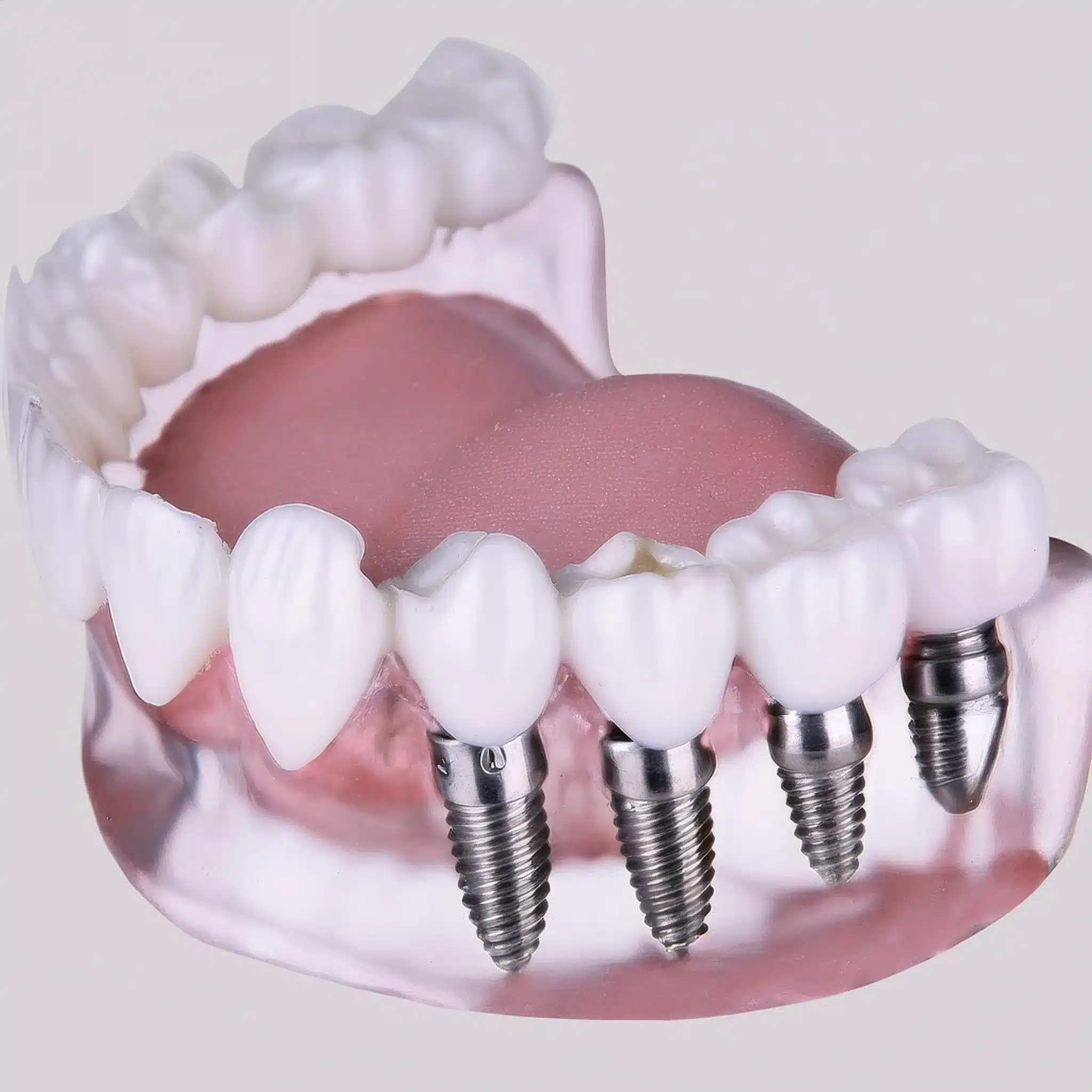 Placement of dental implants for multiple teeth