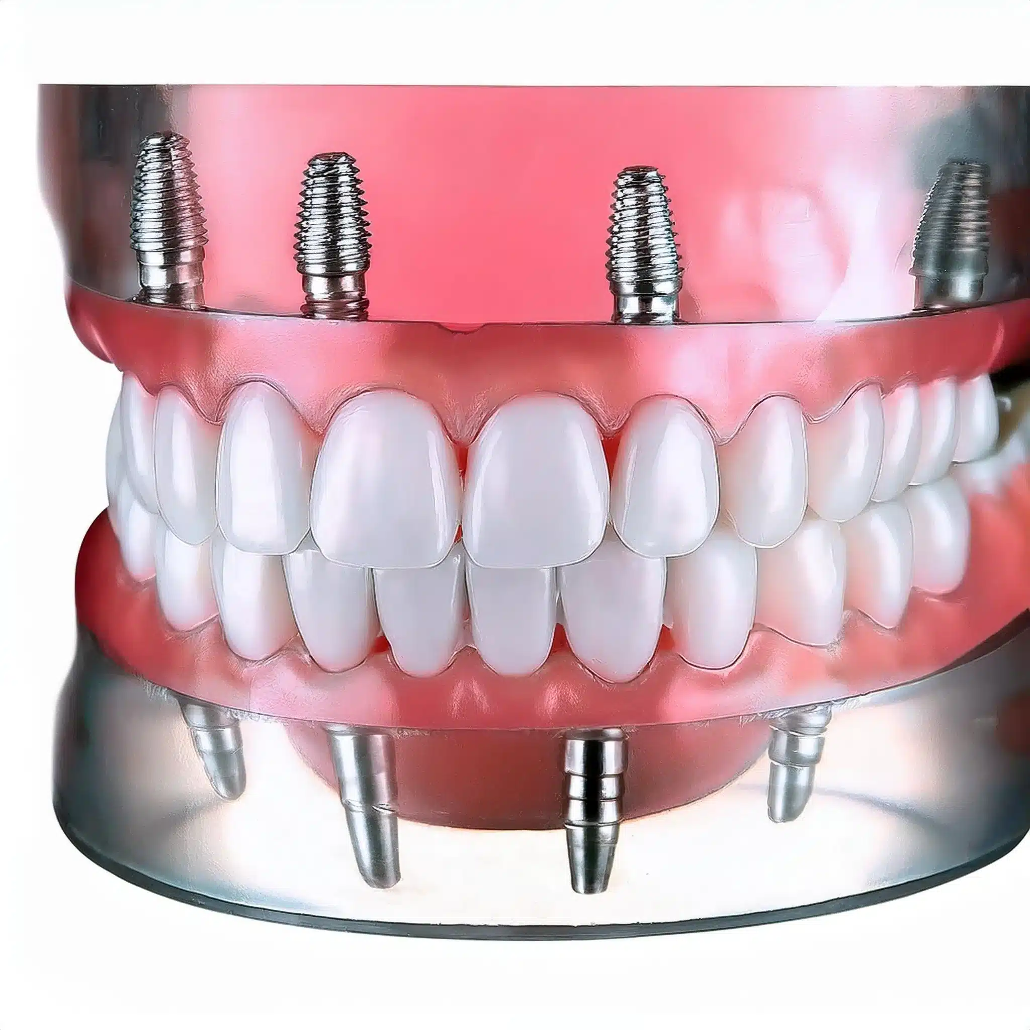 3D plan of full mouth dental implants