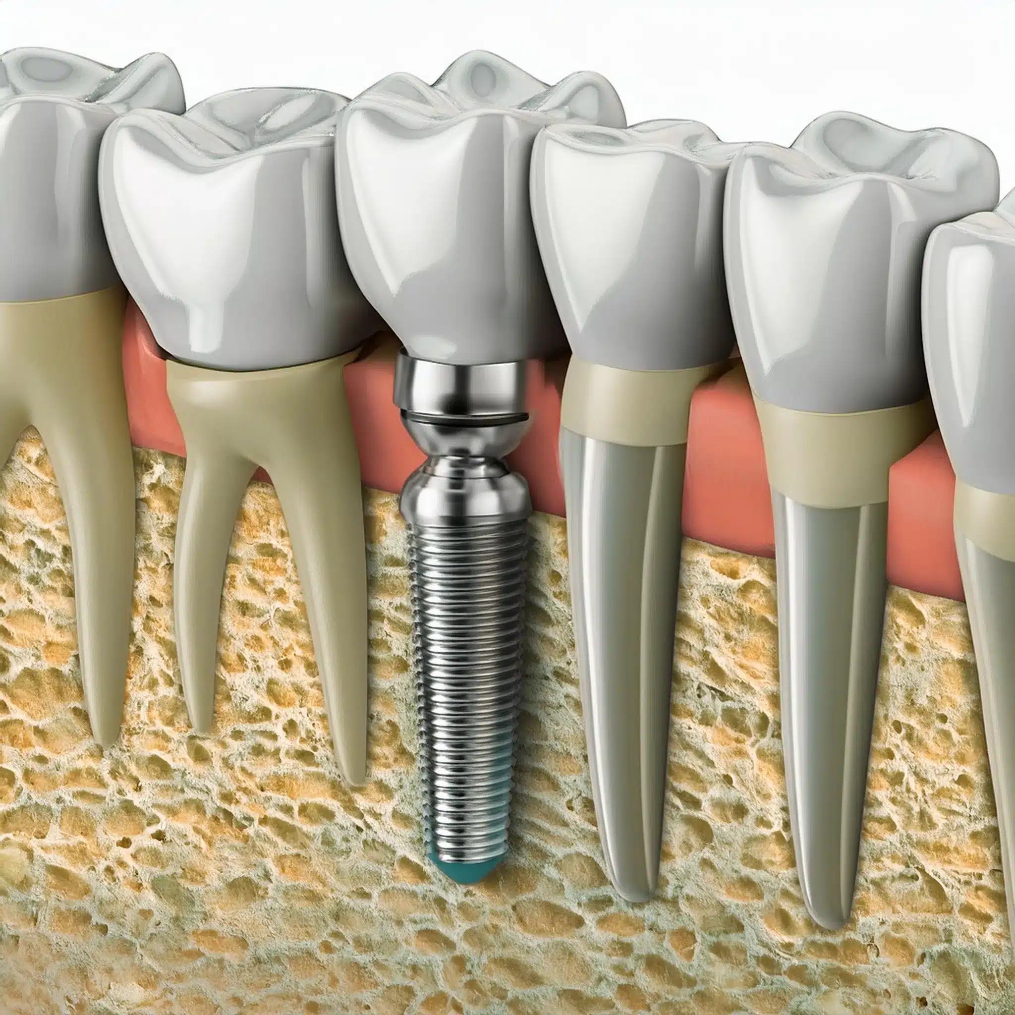 The history of dental implants