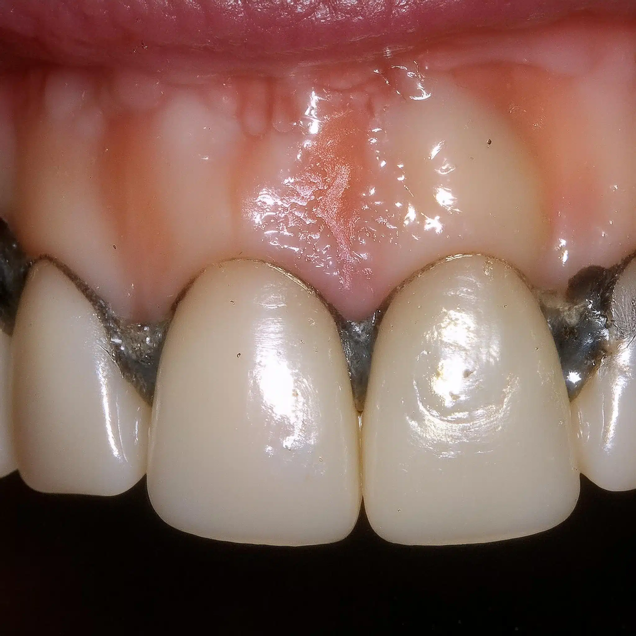 Allergy to dental implants