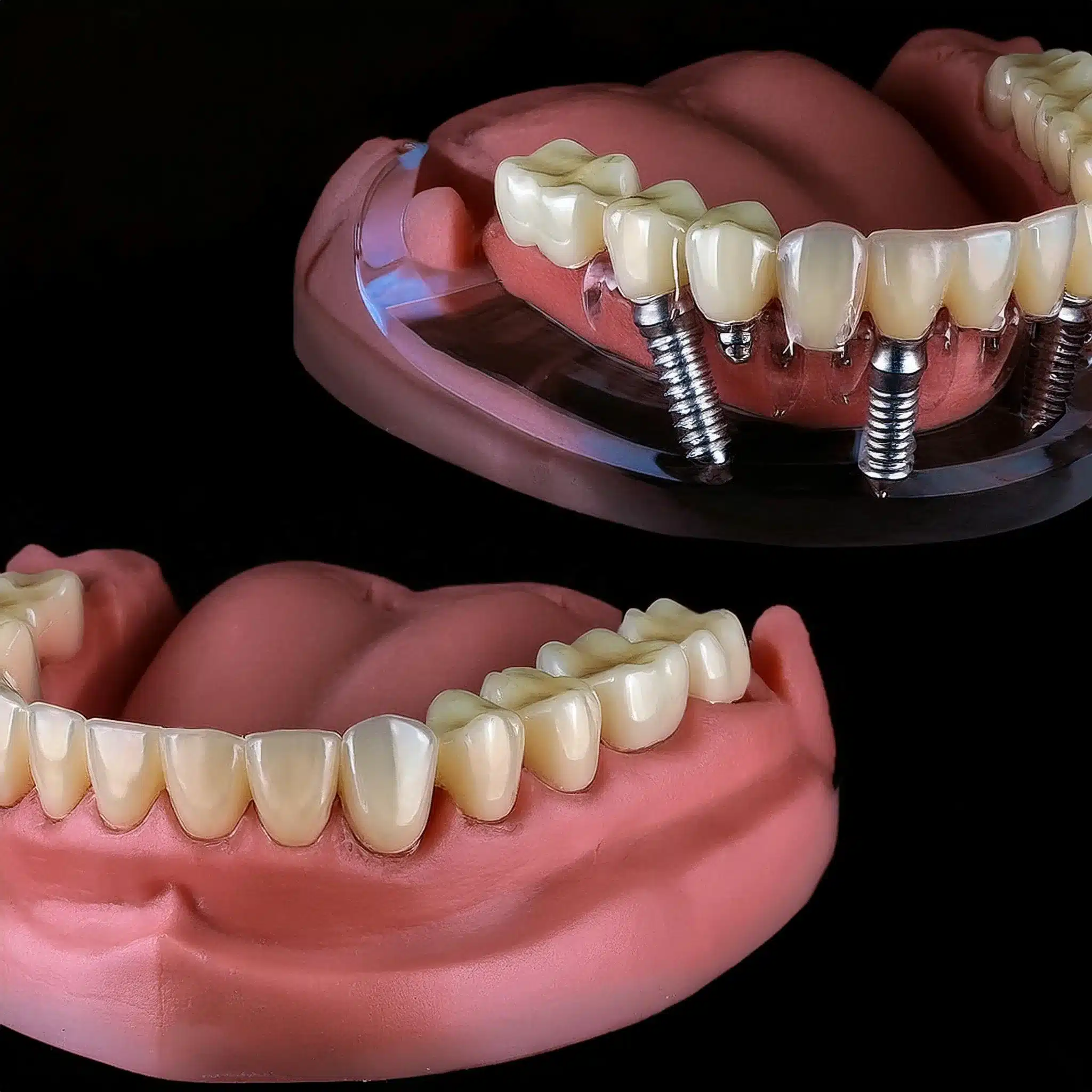 The placement of full mouth dental implants