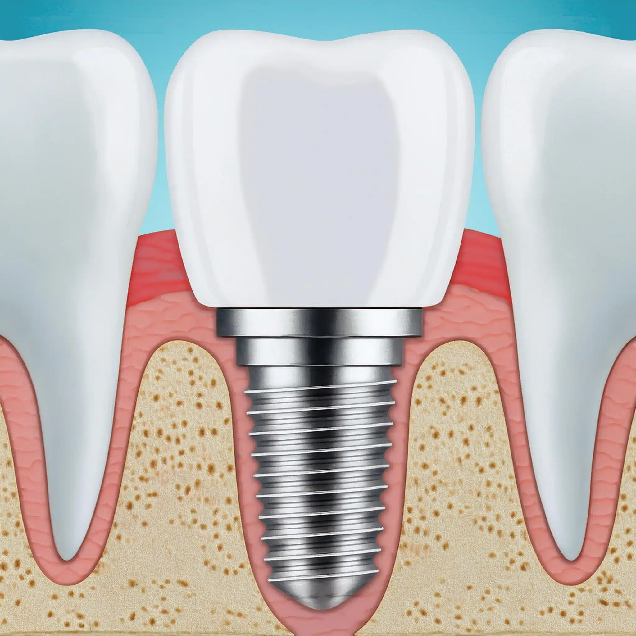 Dental implants