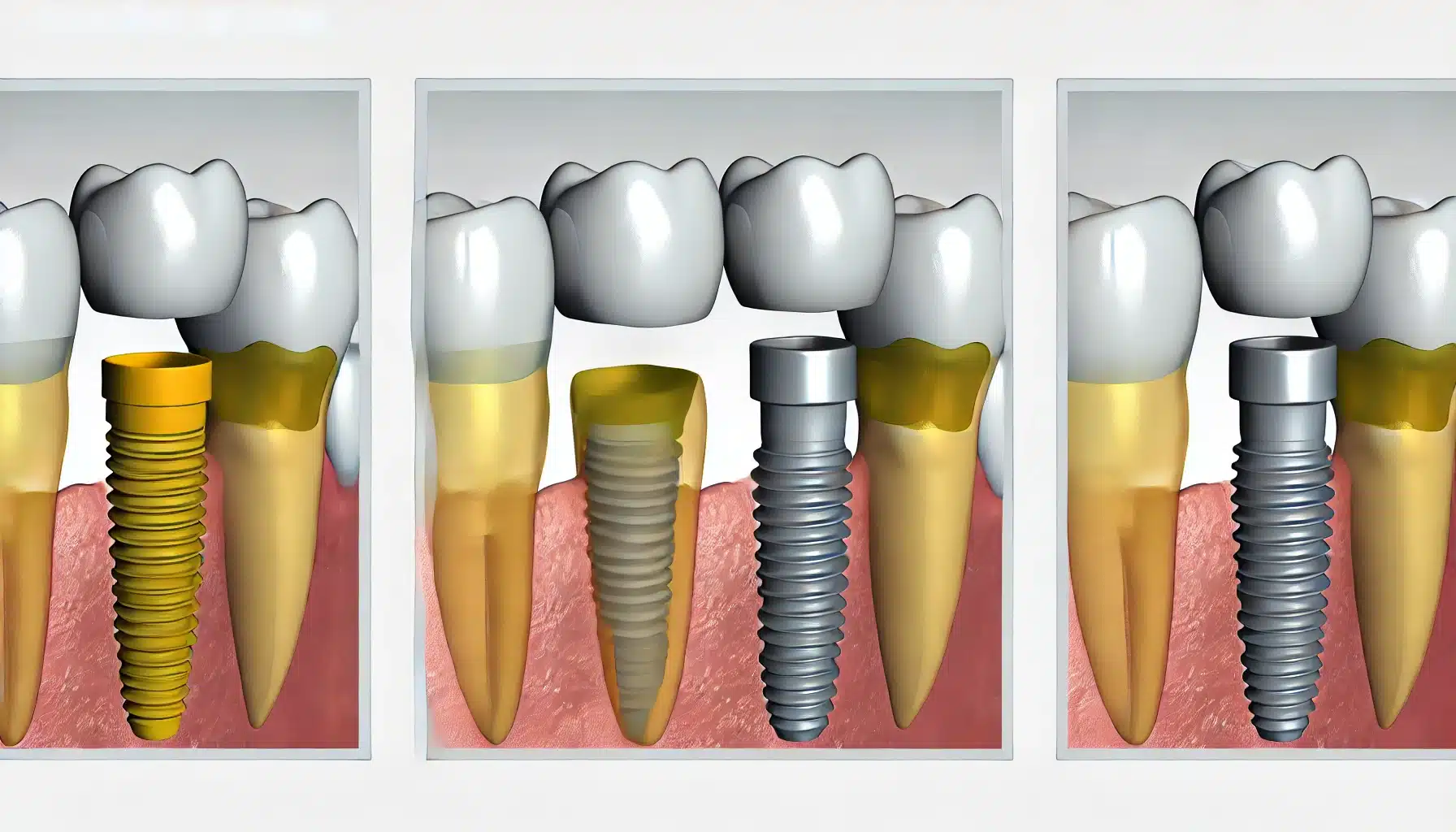 Teeth vs dental implants