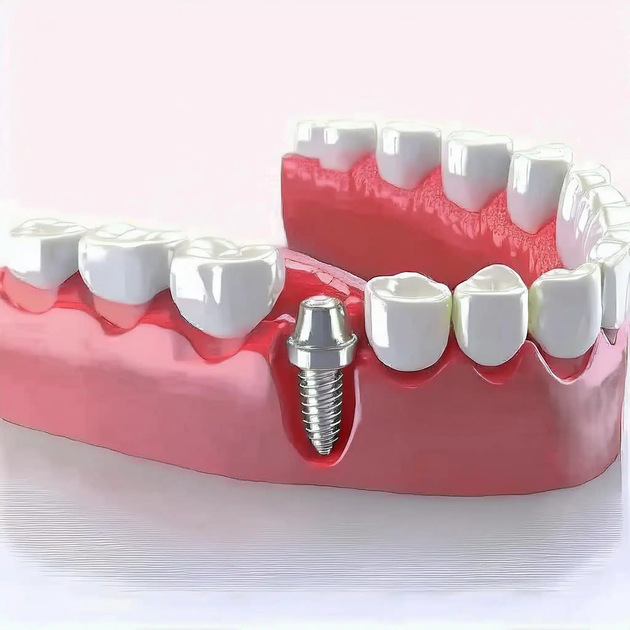 3d plan of dental implants