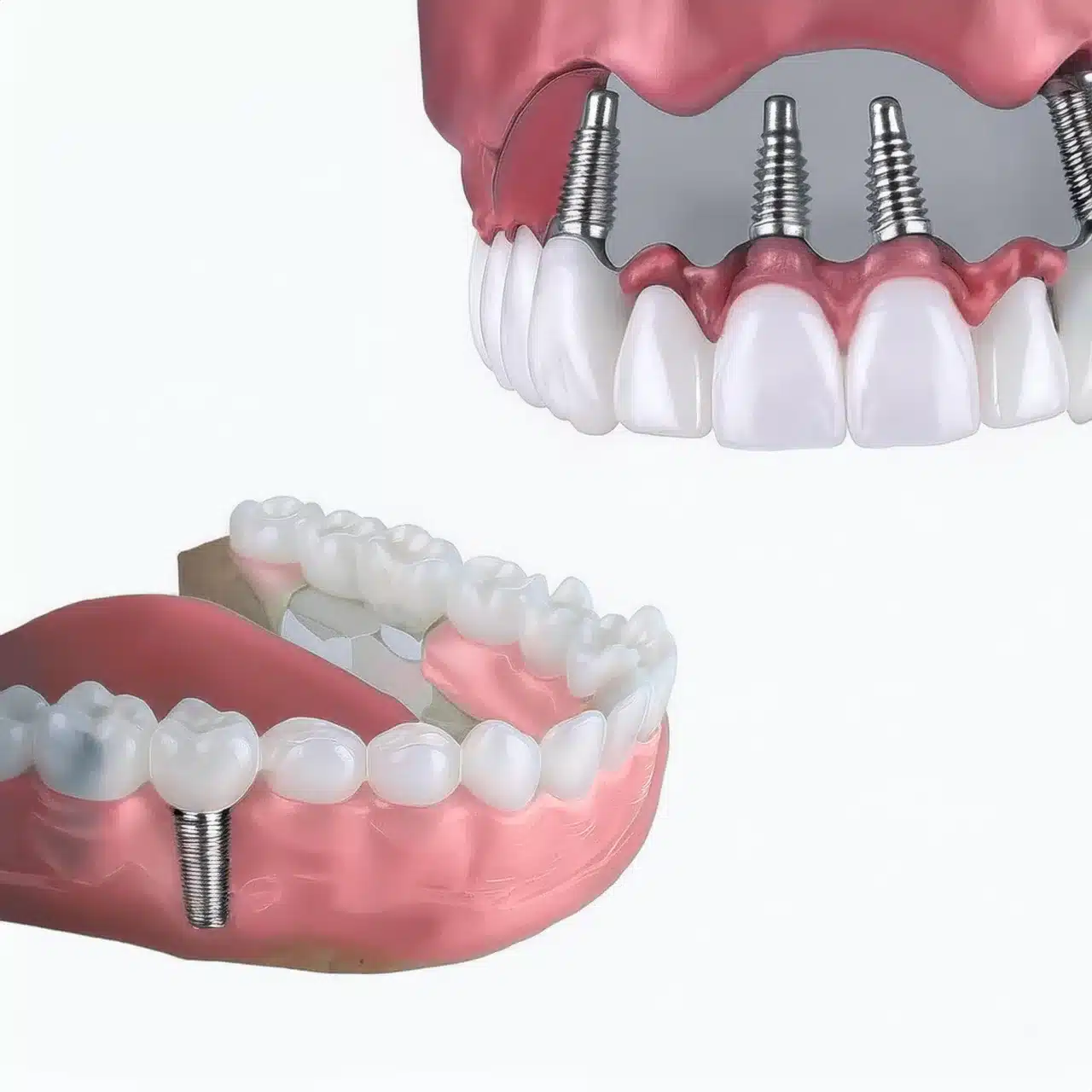 All on 4 vs traditional dental implants