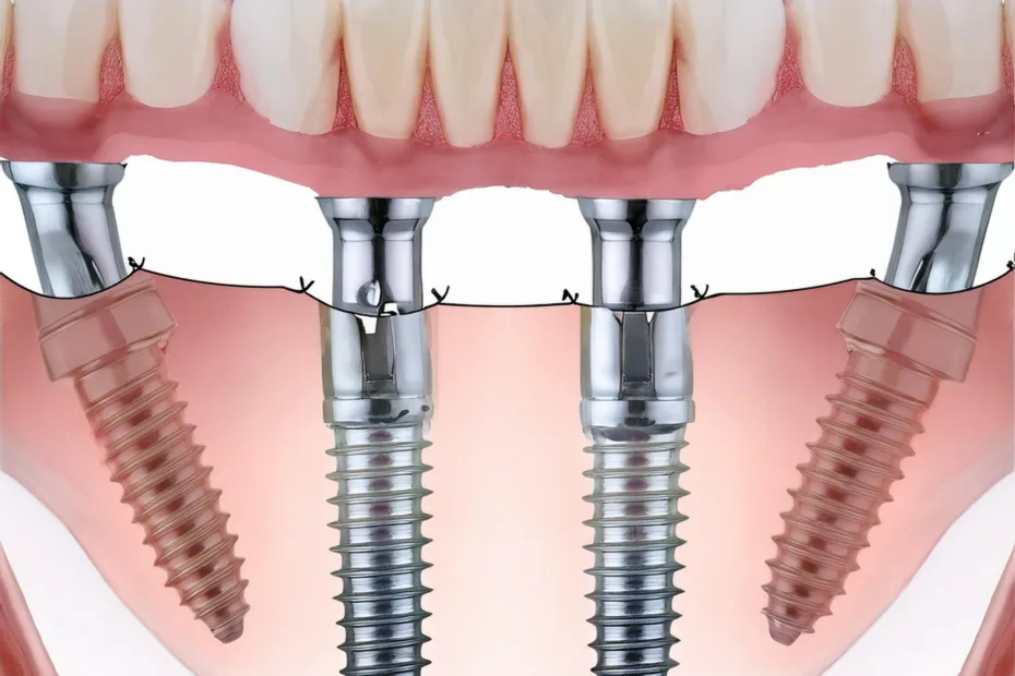 Firefly Generate a 3d and realistic photo of all on 4 dental implants. 10785