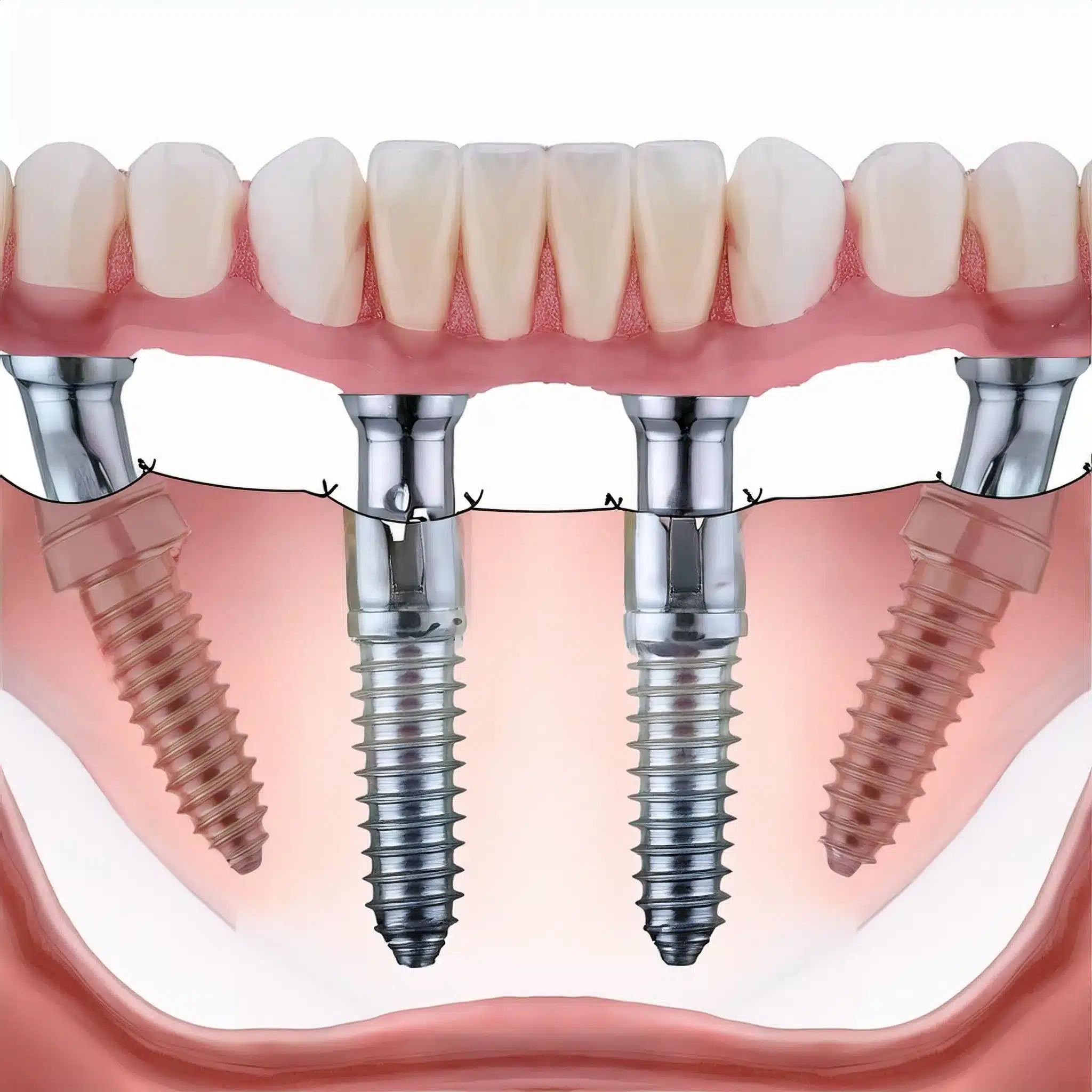 Firefly Generate a 3d and realistic photo of all on 4 dental implants. 10785 jpg