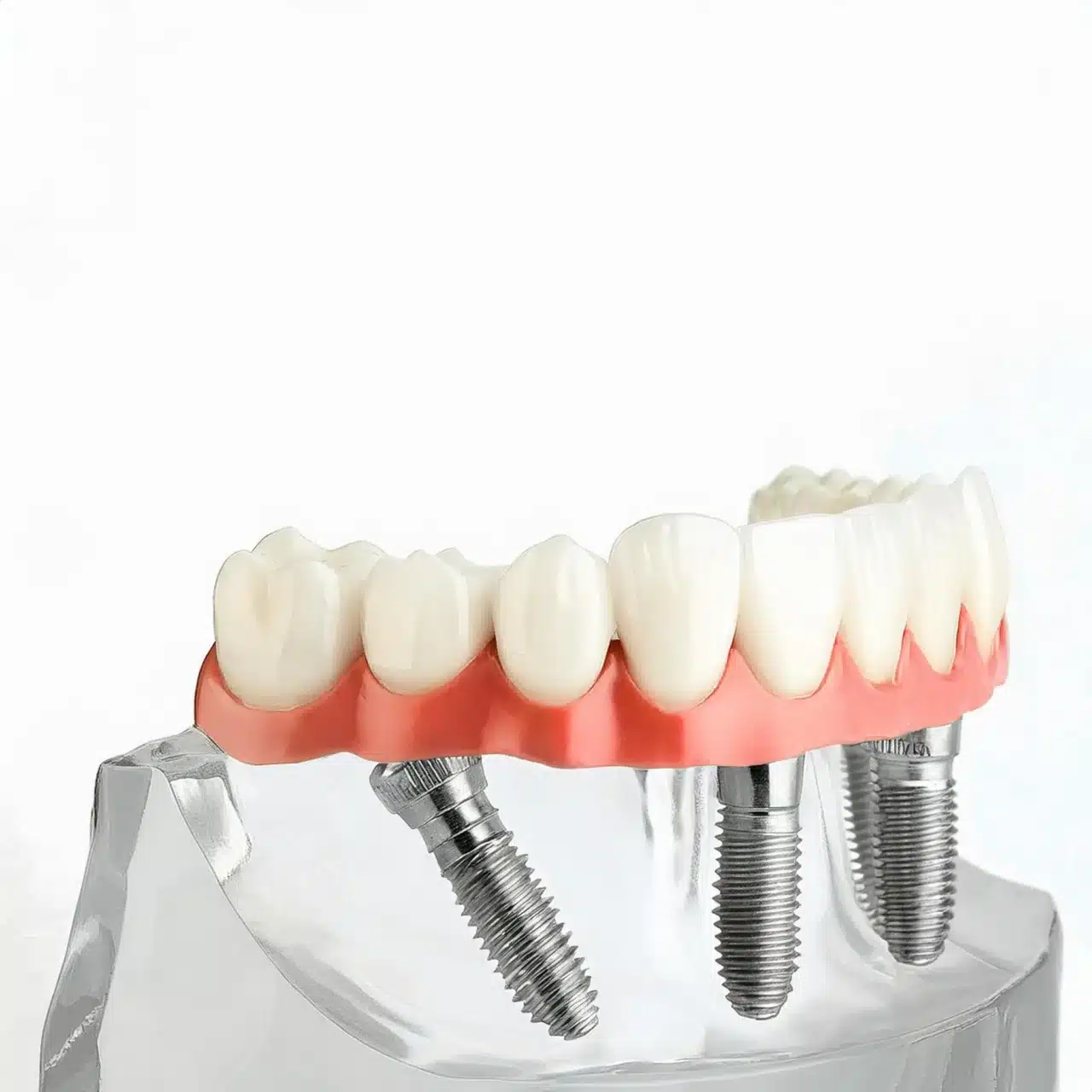 3D plan of all on 4 dental implants