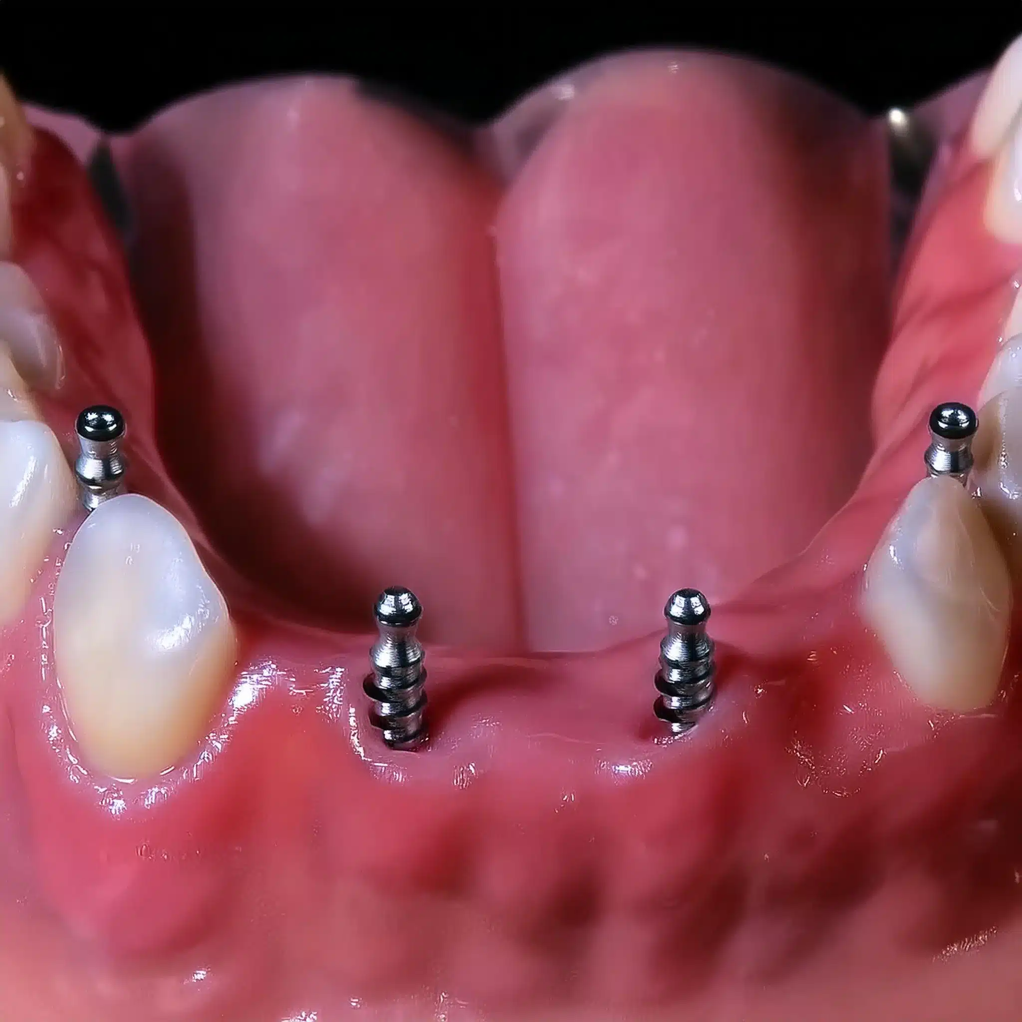 Firefly Generate a 3d and realistic photo that compares dental implants vs crowns. 48608 1 jpg