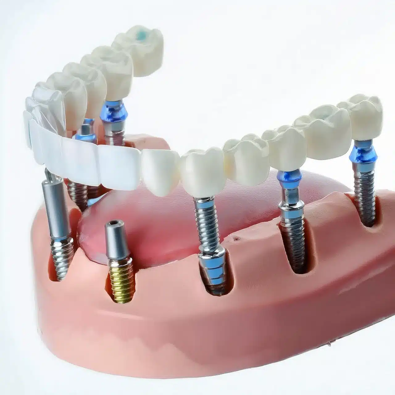 Traditional dental implants