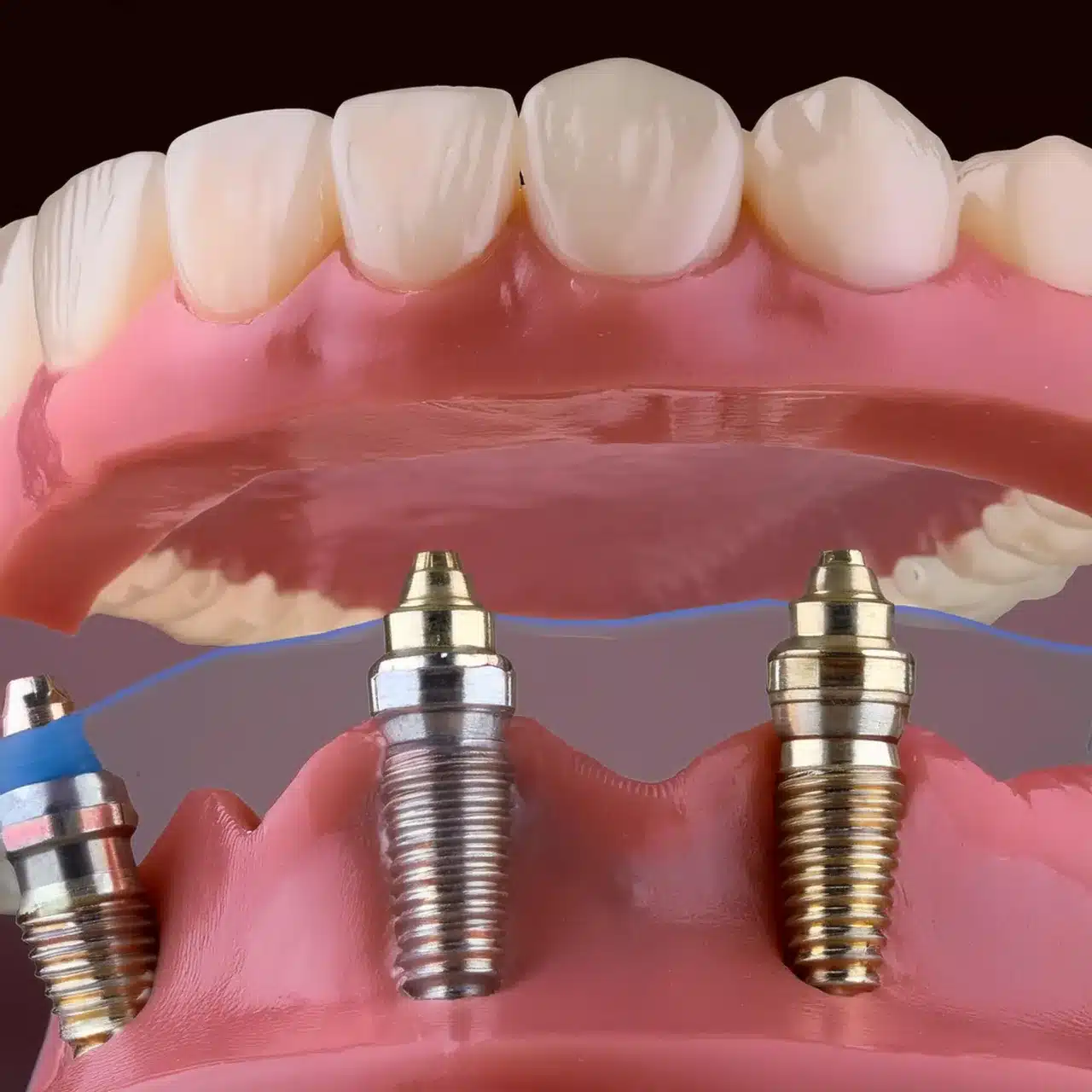 Traditional dental implants