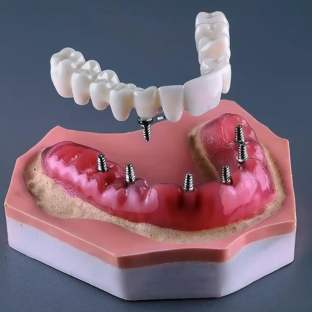 3D plan of mini implants