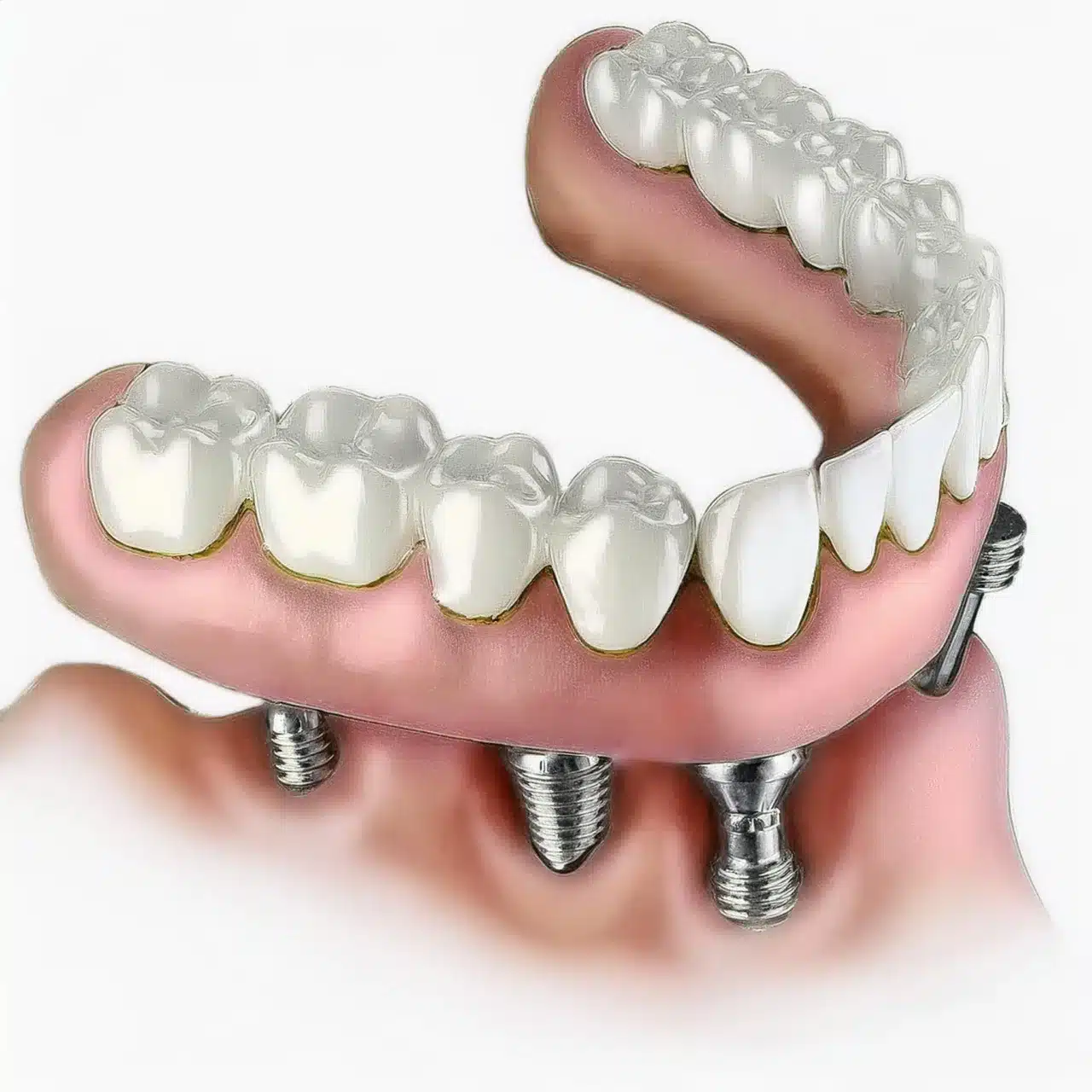 How are porcelans all on 4 implant placement?