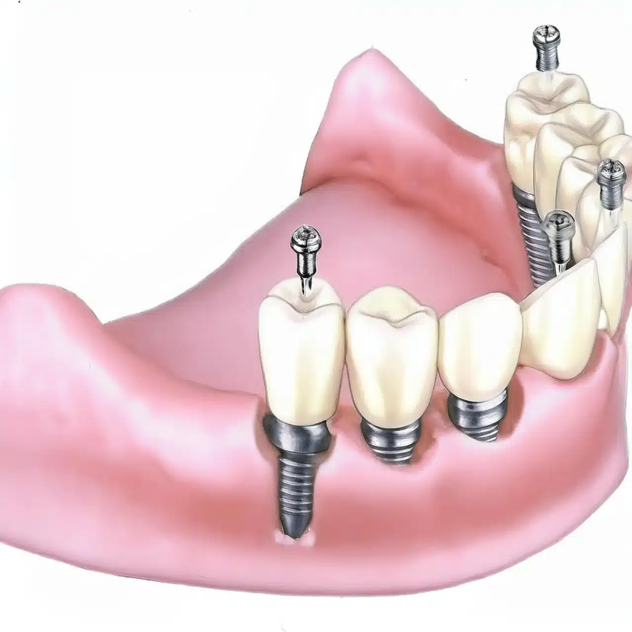 Impianti dentali in acrilico tutti su 4