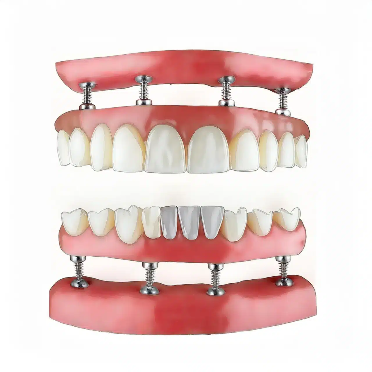 An example of all on 4 dental implants