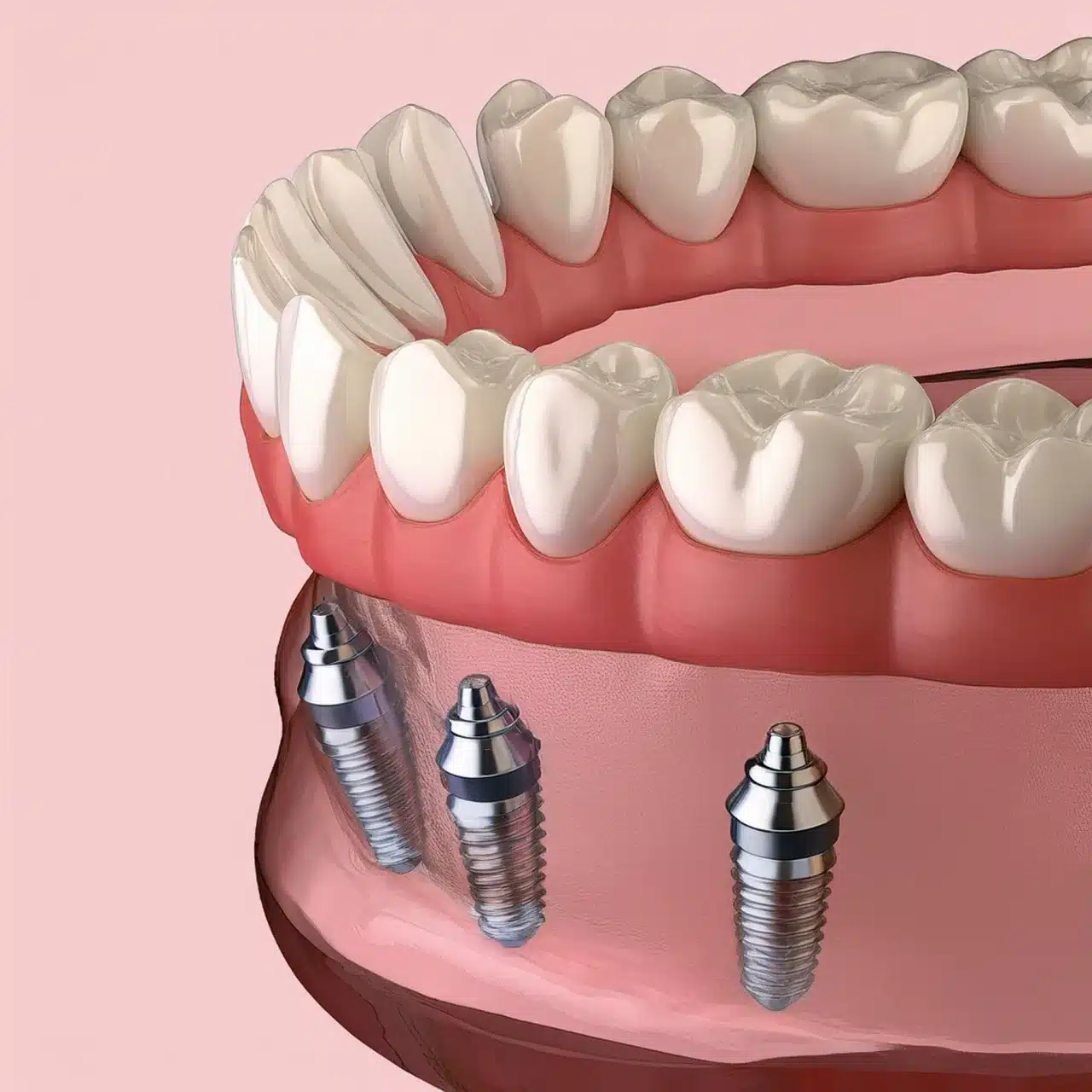 Prothèses dentaires Snap-in avec implants