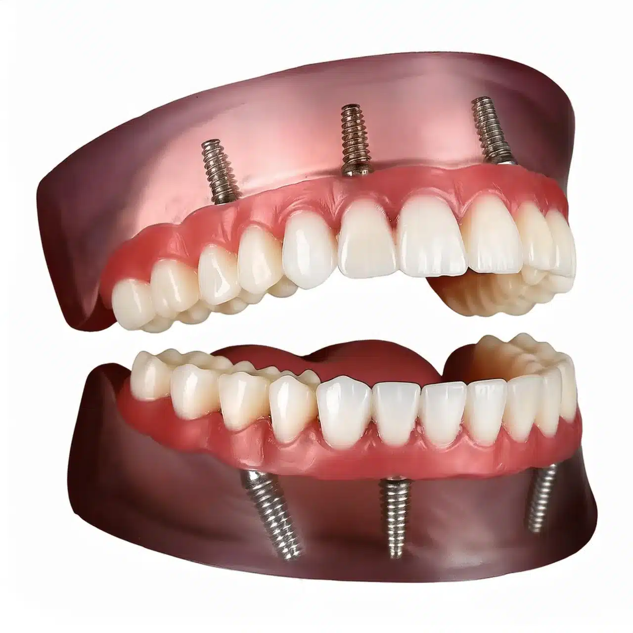 Plani 3D i të gjithave në 4 implante dentare