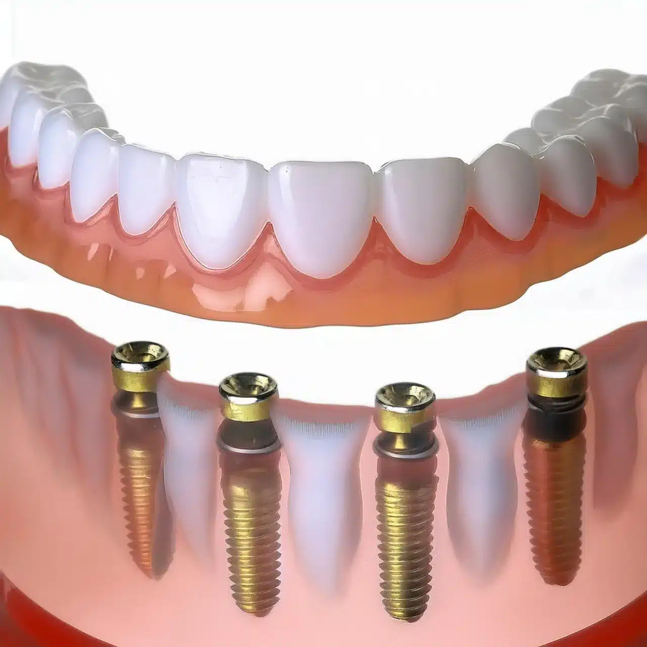 Procedimiento de implantes dentales All on 4