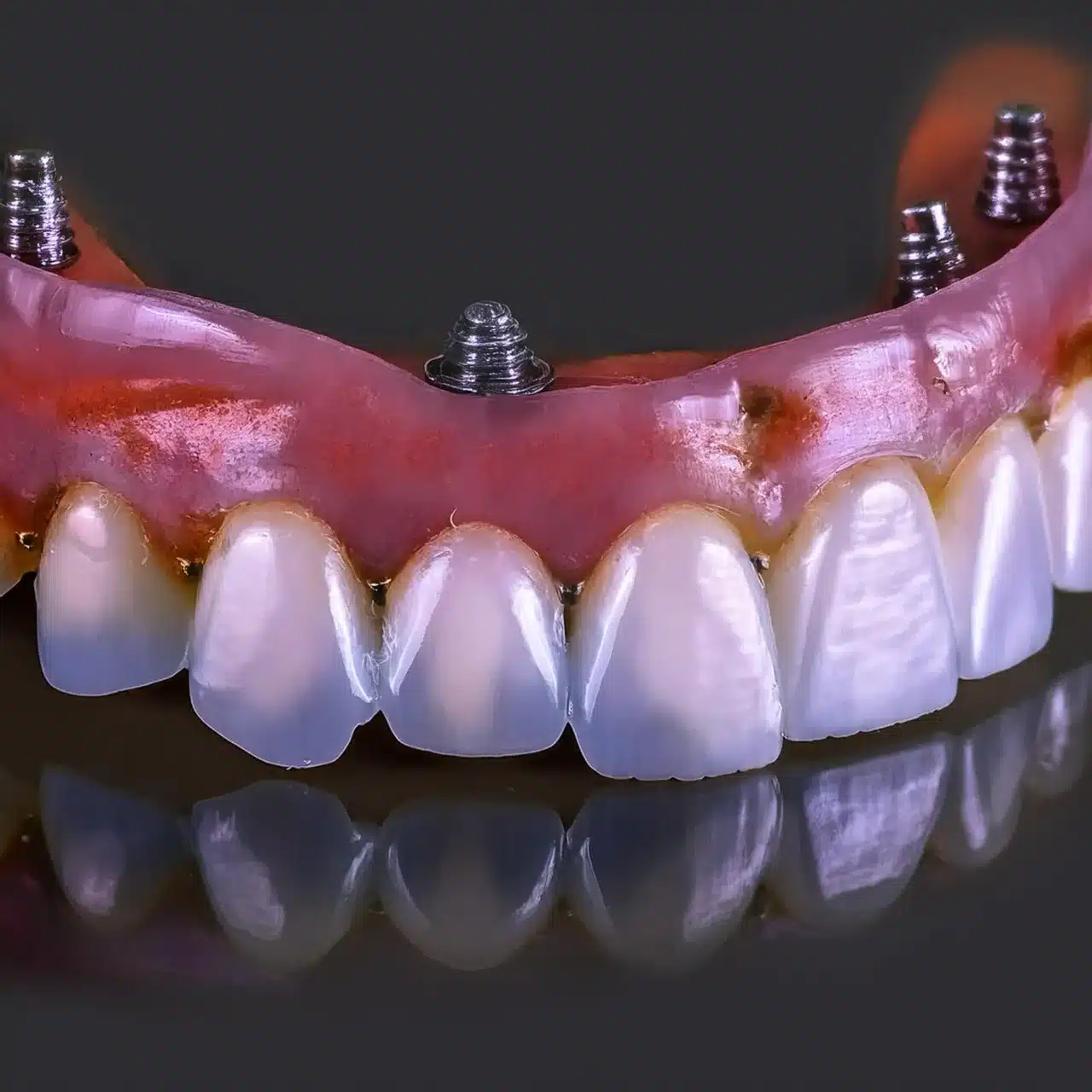 Plano 3D de todos sobre 4 implantes dentales