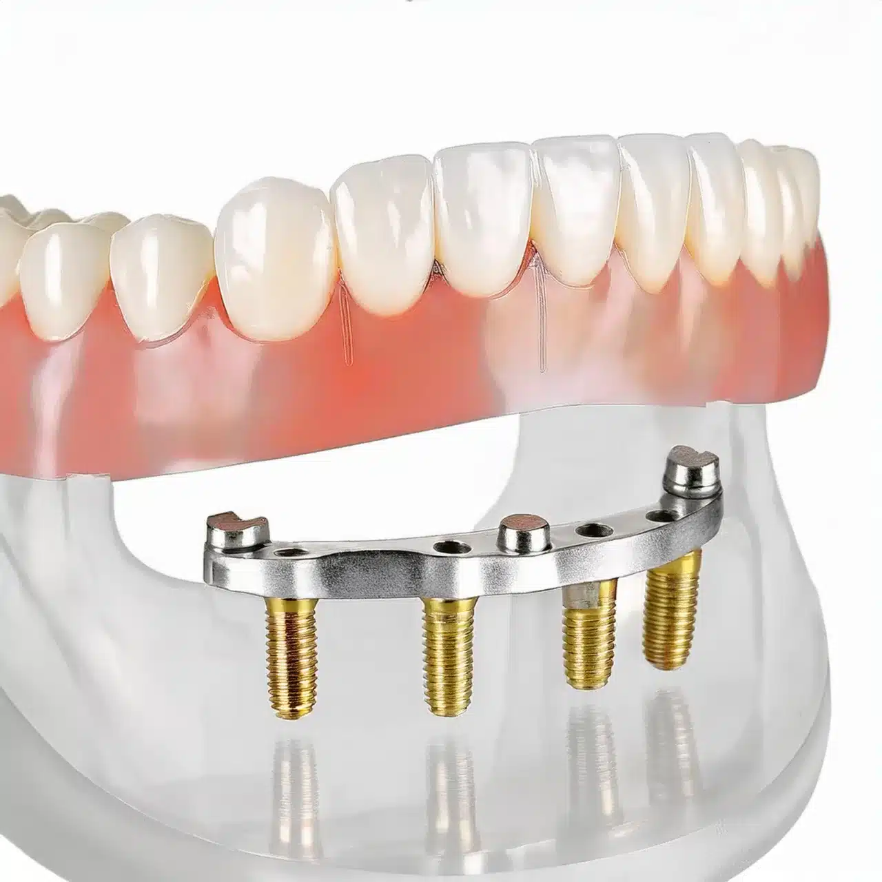 Firefly Generar una foto realista y en 3D de todos en 4 implantes dentales. 51362