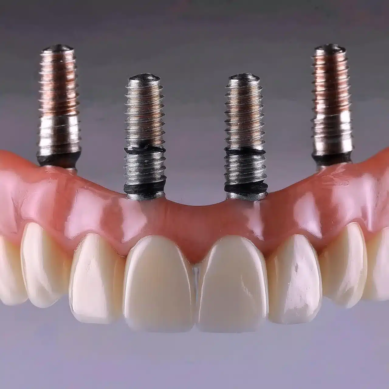 ¿Cómo se añaden los implantes dentales all on 4?