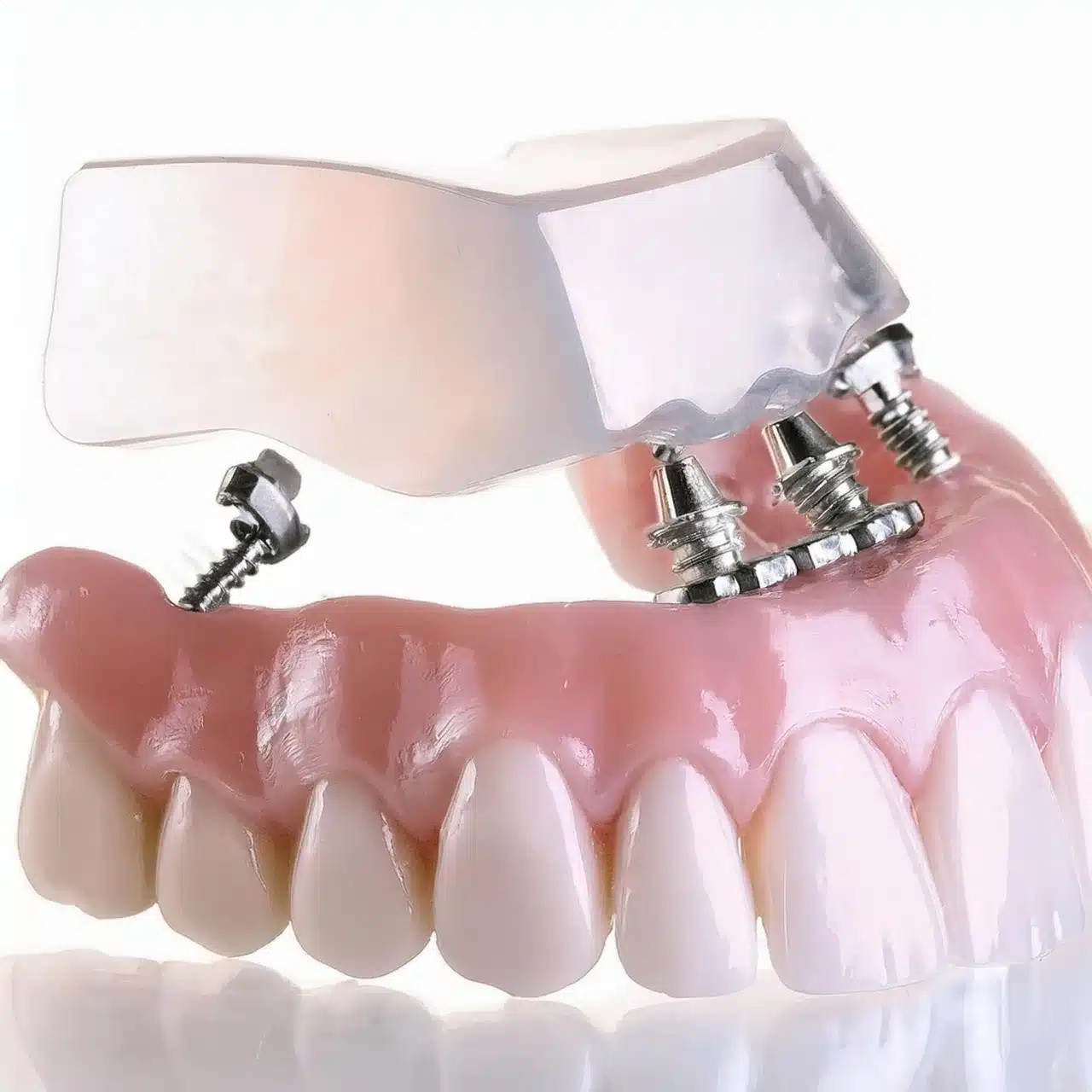 Implantes dentales All on 4