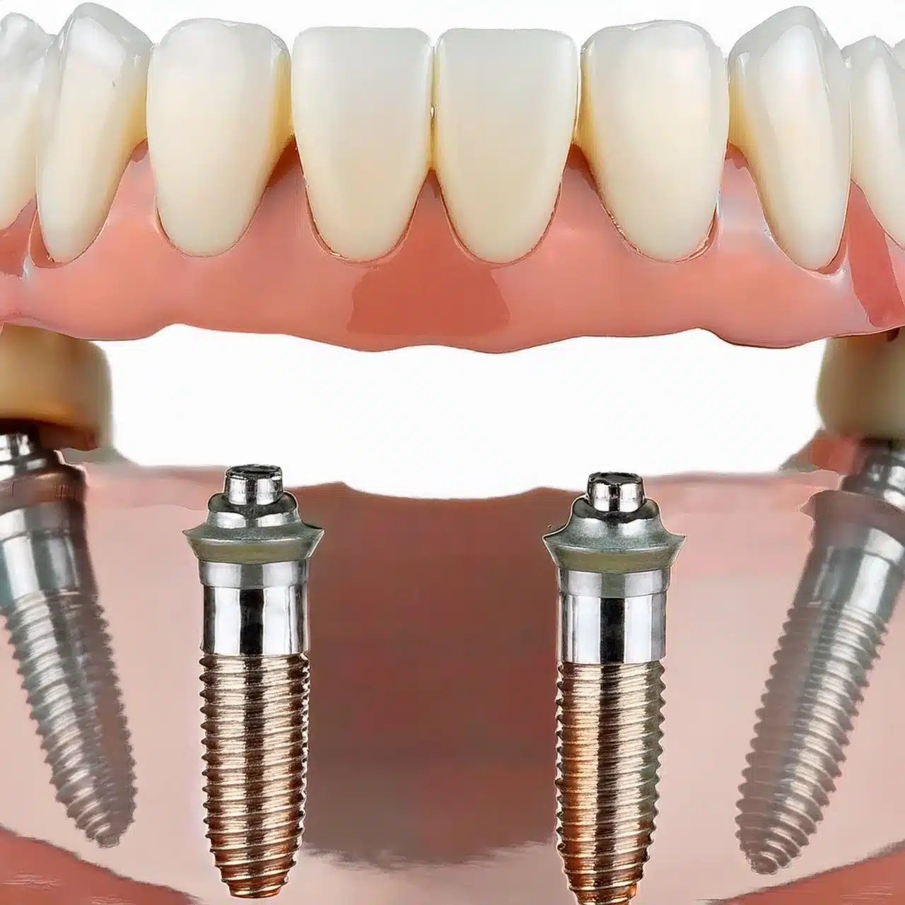 Implantes dentales angulados all on 4