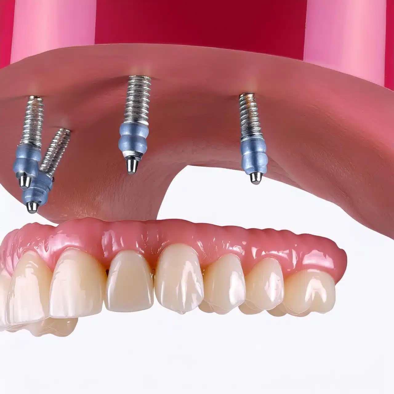 Implantes dentales estándar All on 4