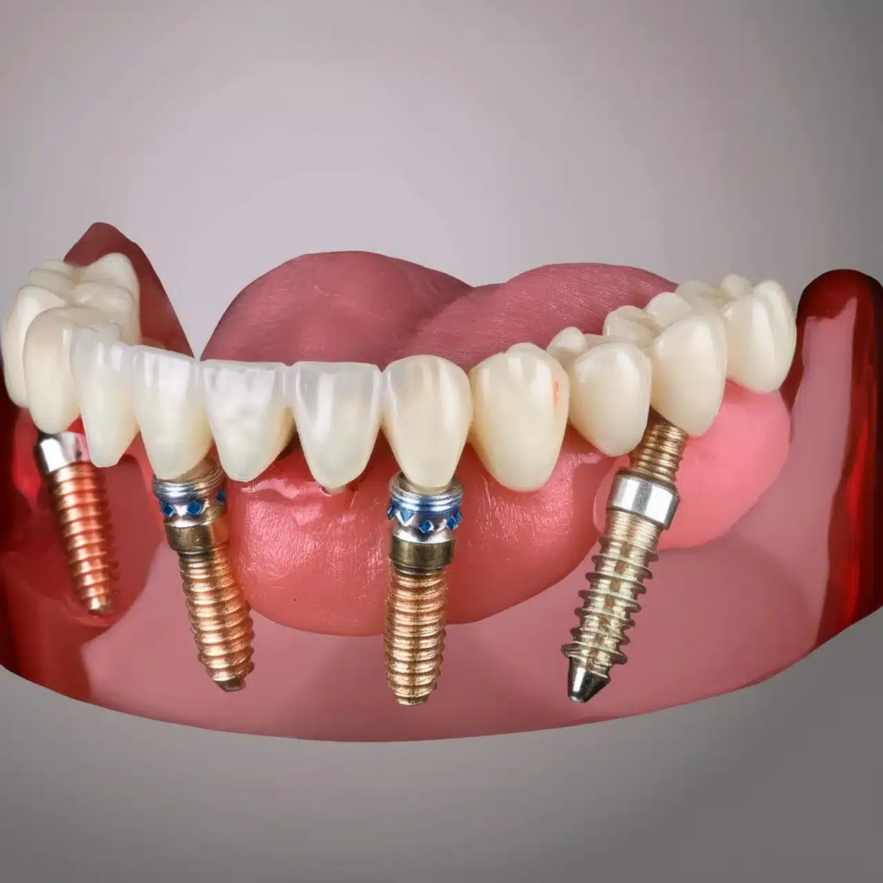 Plano 3D de todos sobre 4 implantes dentales