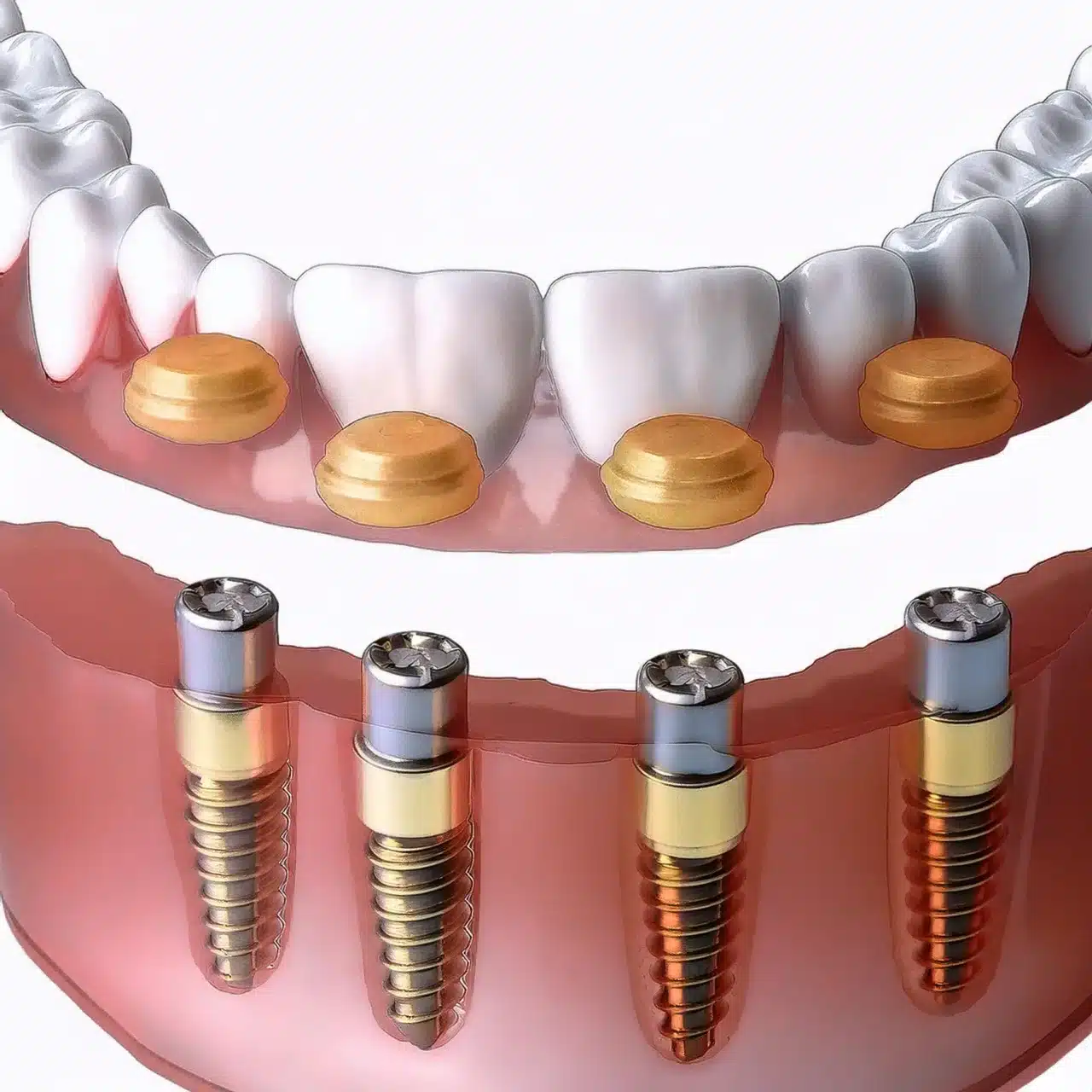 How does full mouth all on 4 implants work?