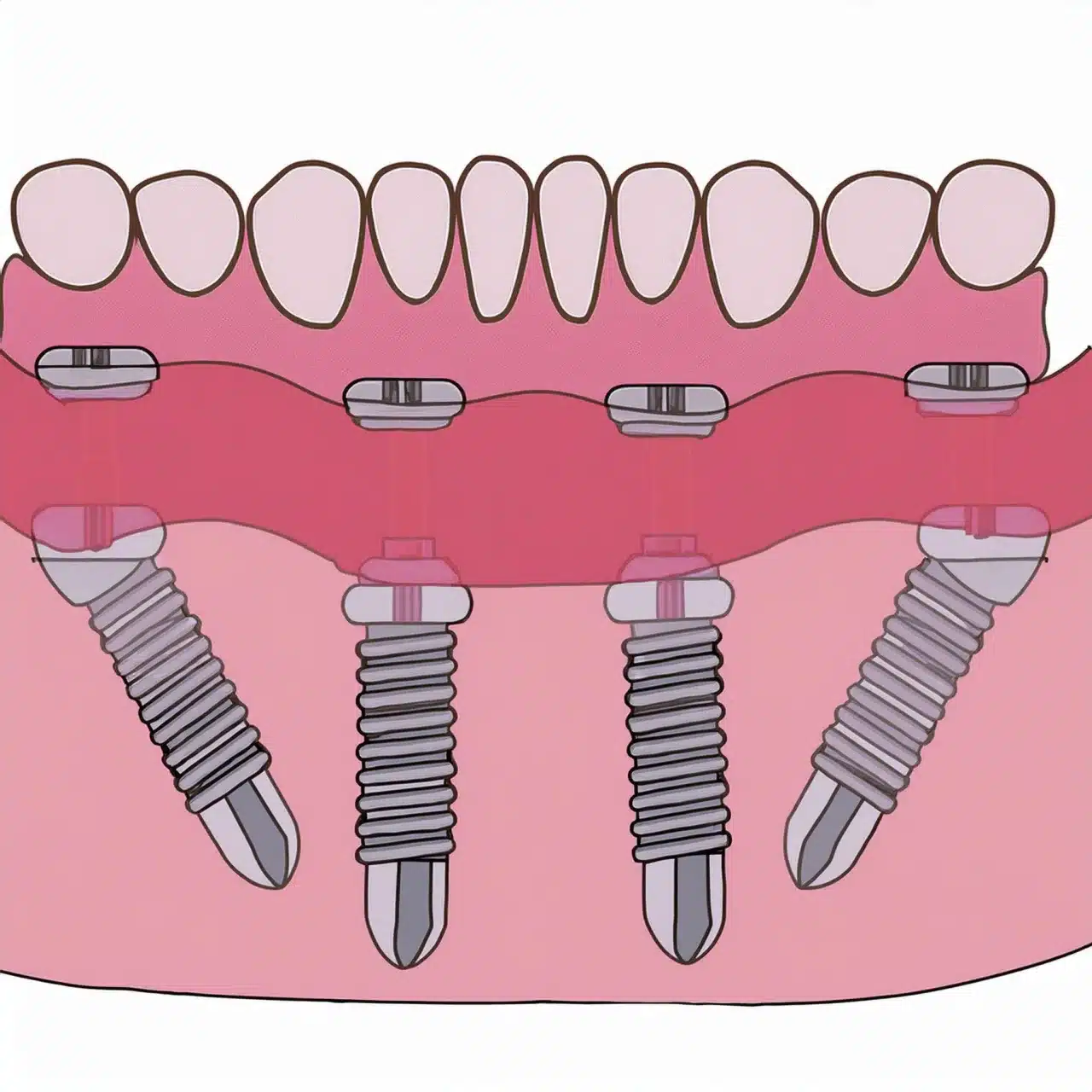 Demonstartion of angled all on 4 dental implants