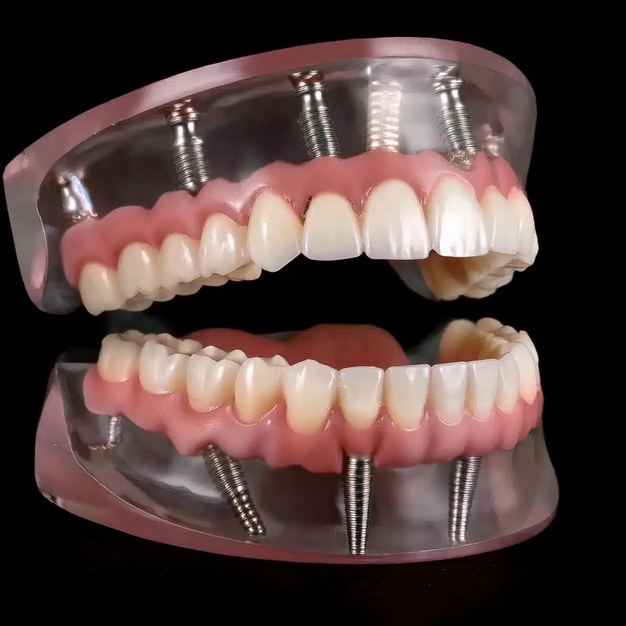 Piano 3D di tutti i 4 impianti dentali