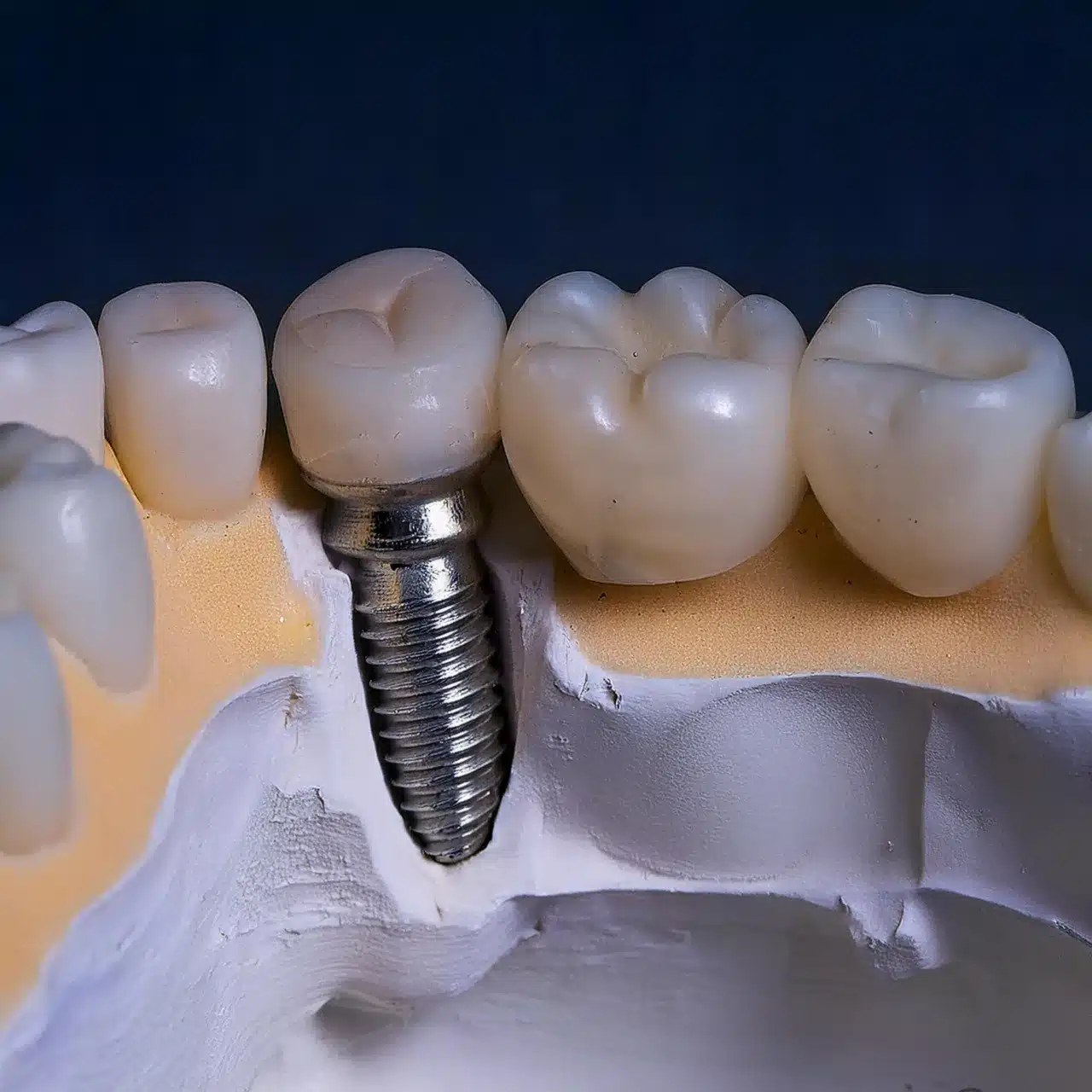 Procedimiento de implantes dentales