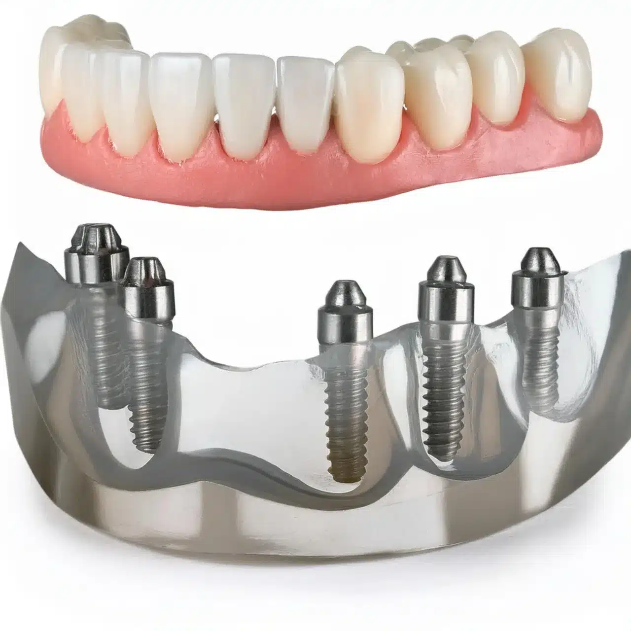 How are all on 4 dental implants placement