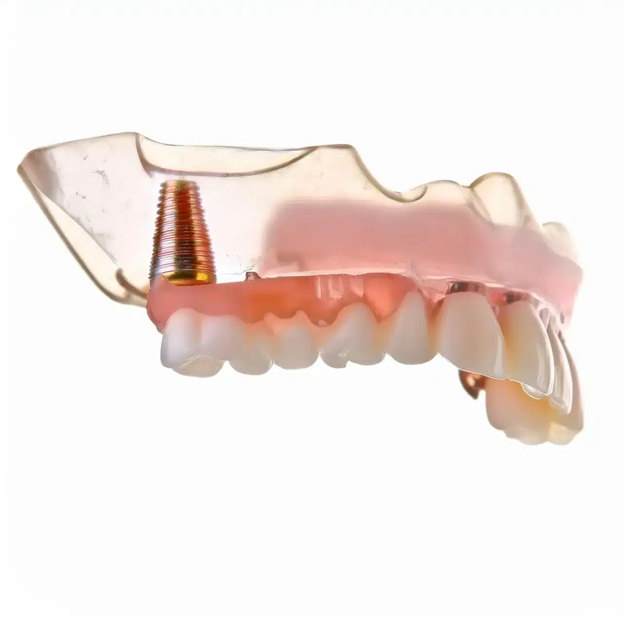 3D plan of immediate allon 4 dental implants