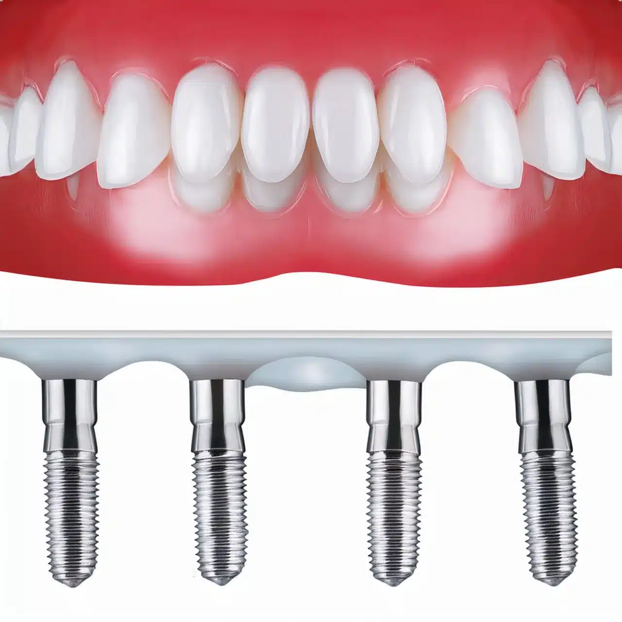 All on 4 dental implants procedure