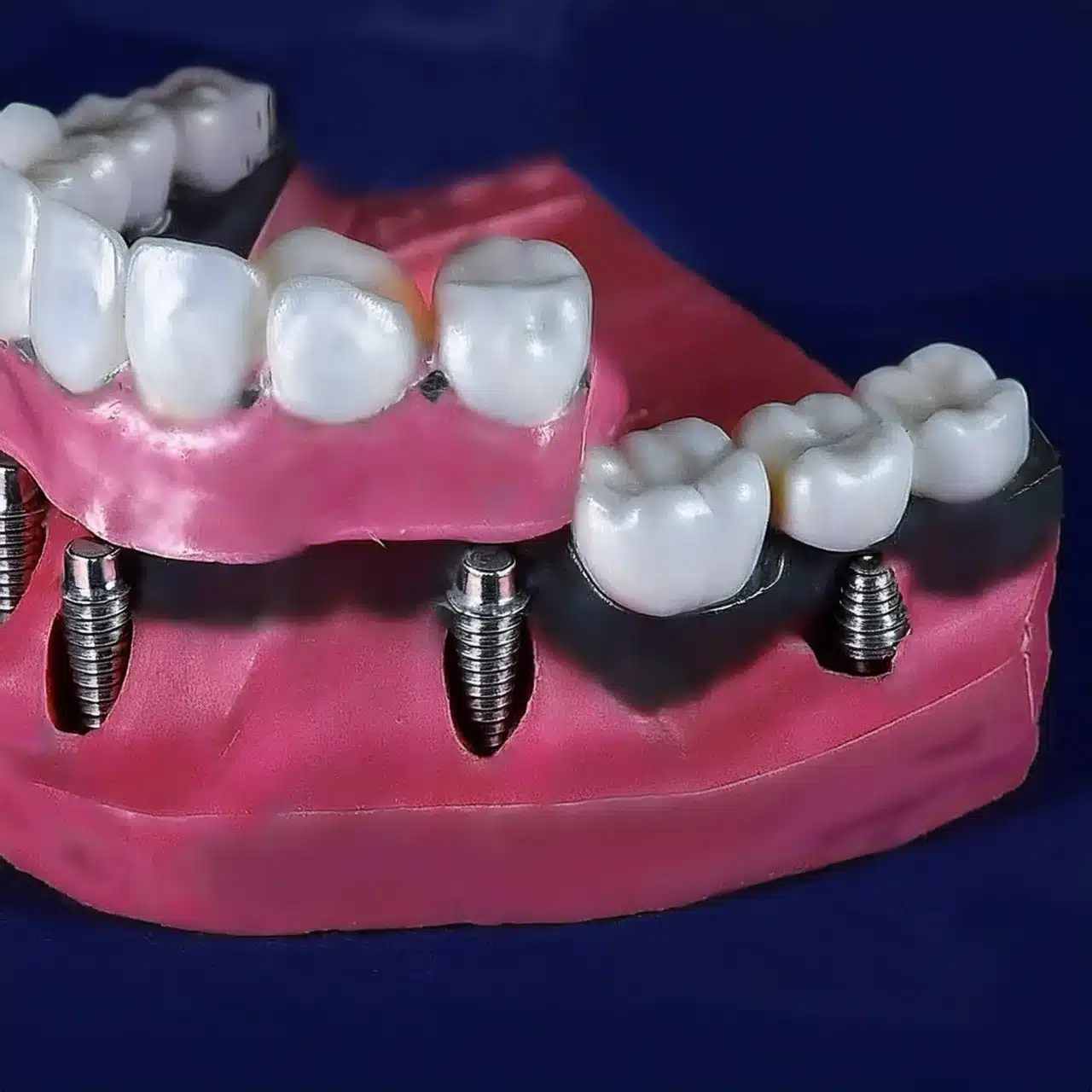 Plani 3D i të gjithave në 4 implante dentare