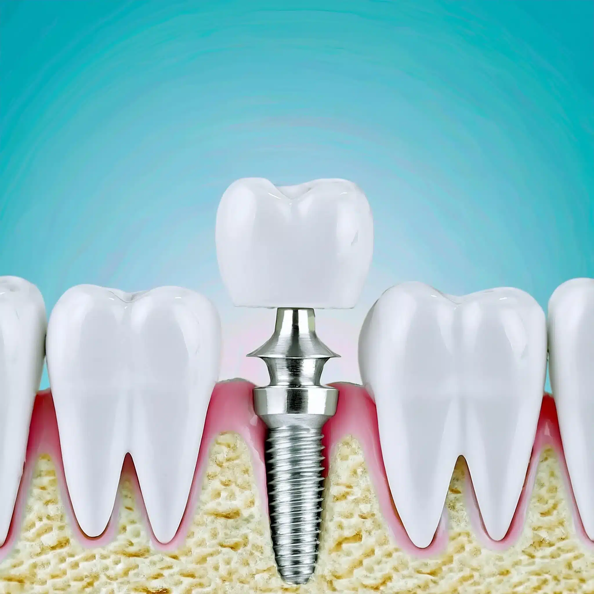 How is a dental implant added?