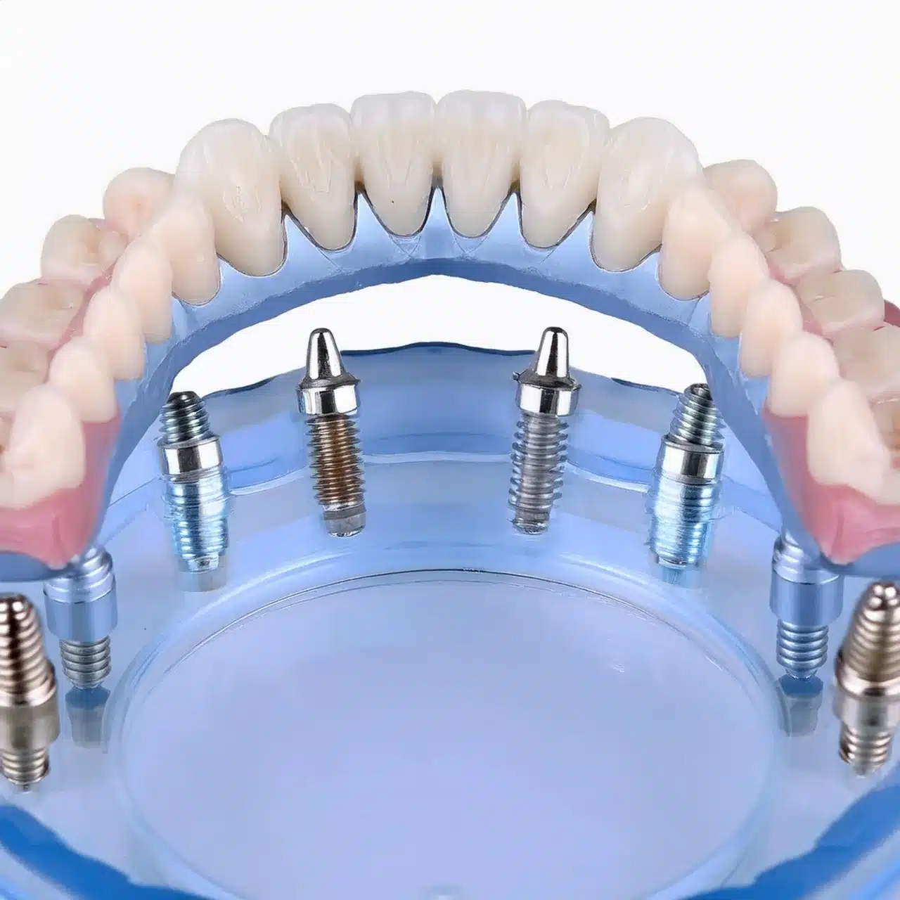 Impianti dentali all on 8