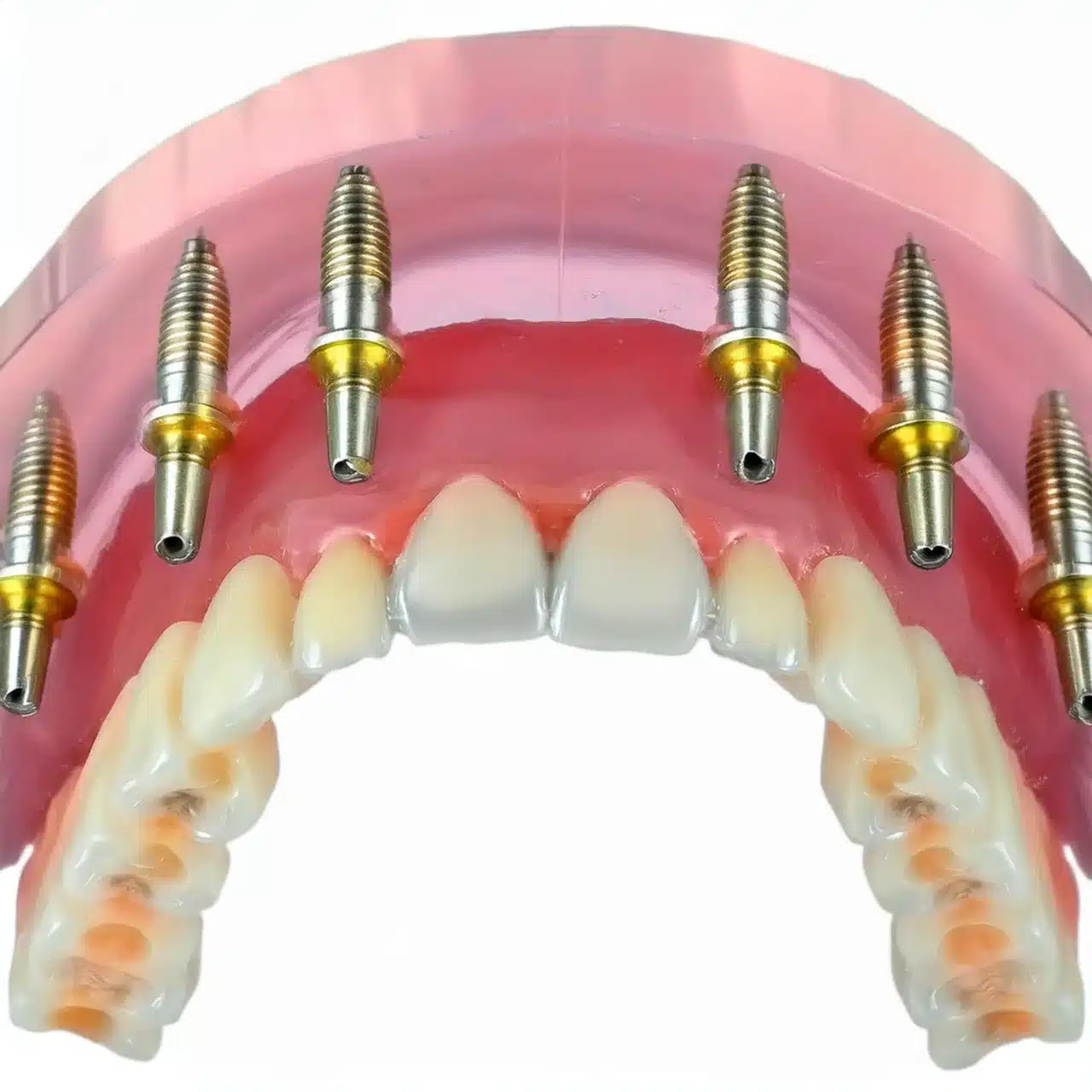 Tutti su 6 impianti dentali