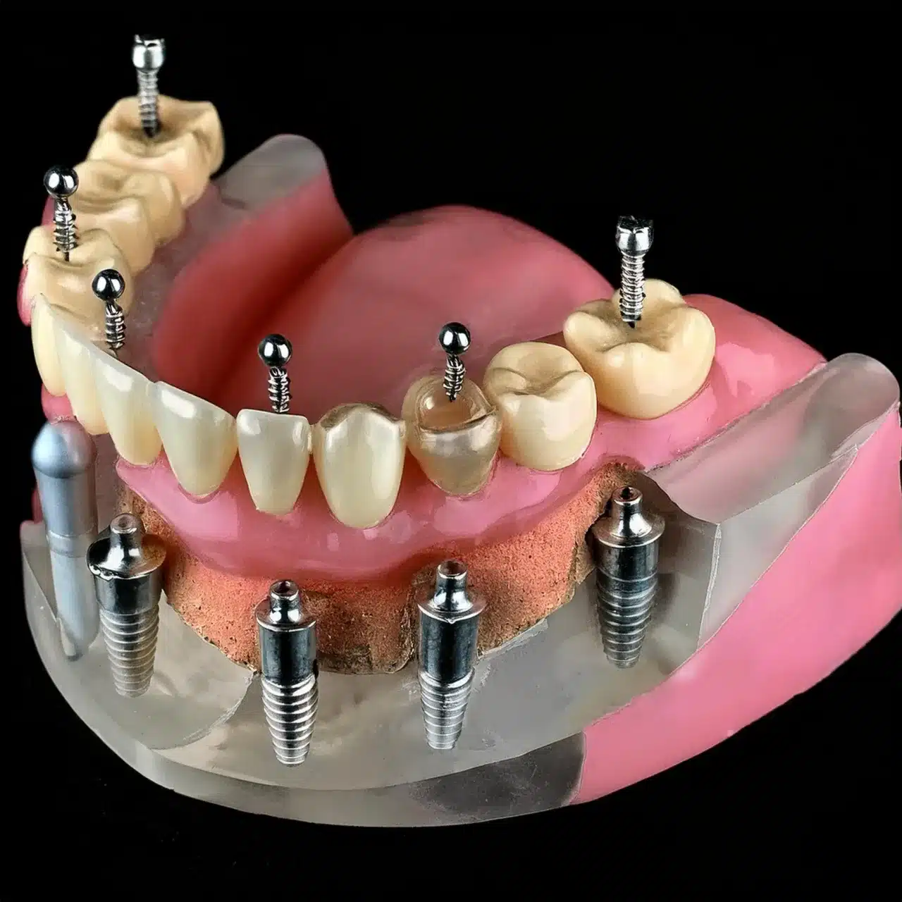 Piano 3D di tutti i 6 impianti dentali