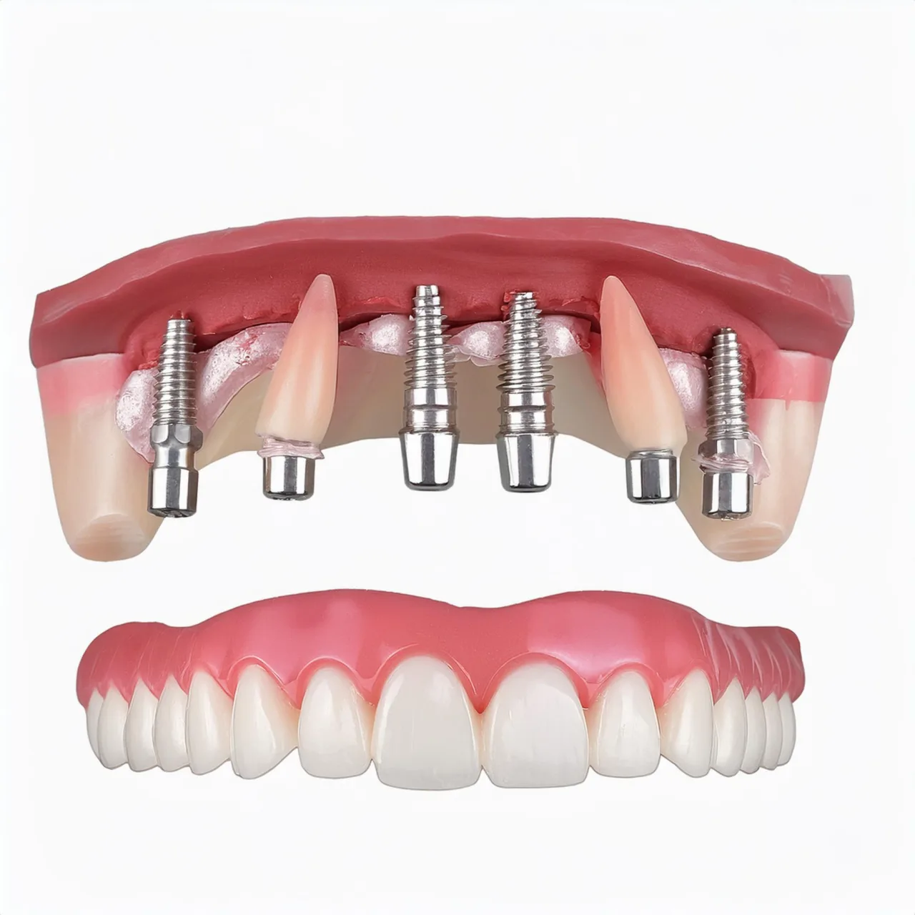 All on 6 dental implants for bone grafting